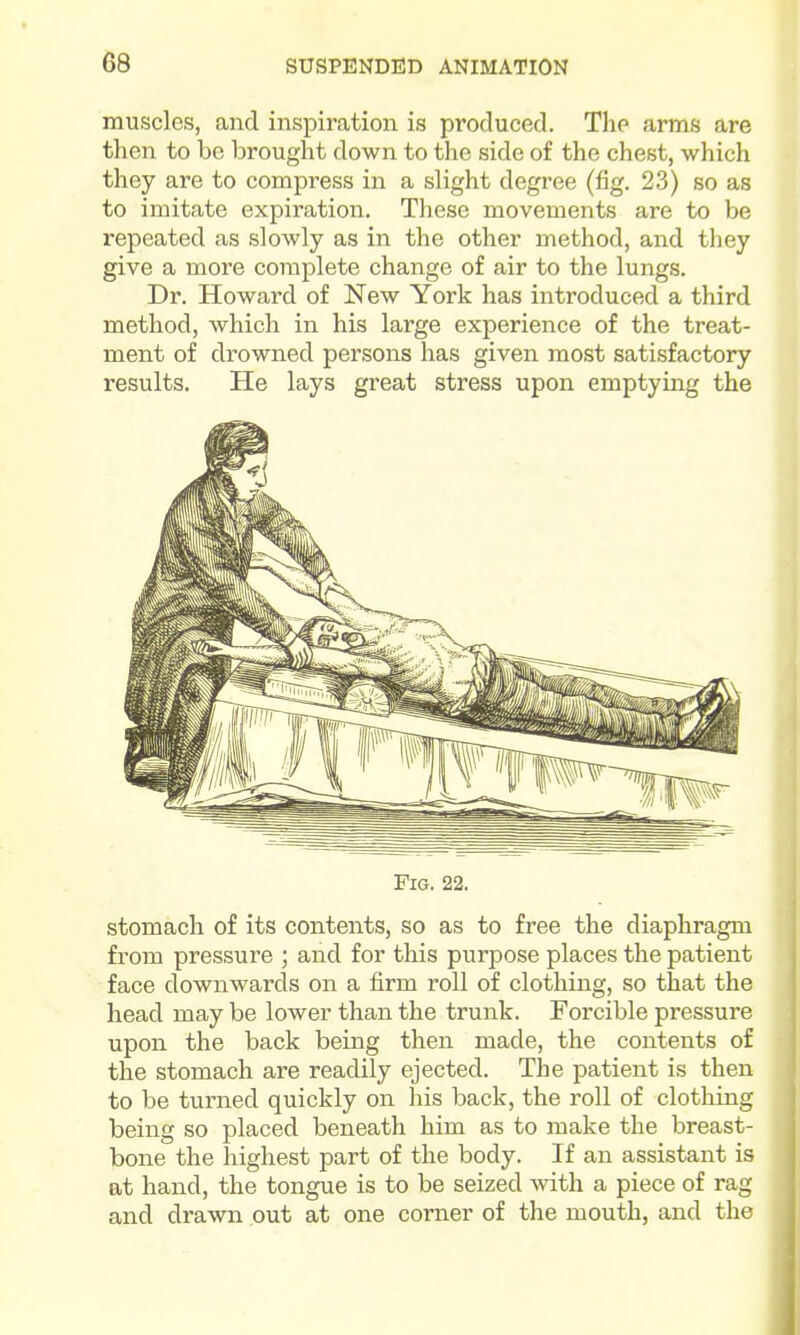muscles, and inspiration is produced. The arms are then to be brought down to the side of the chest, which they are to compress in a slight degree (fig. 23) so as to imitate expiration. These movements are to be repeated as slowly as in the other method, and tliey give a more complete change of air to the lungs. Dr. Howard of New York has introduced a third method, which in his large experience of the treat- ment of drowned persons has given most satisfactory results. He lays great stress upon emptying the Fig. 22. stomach of its contents, so as to free the diaphragm from pressure ; and for this purpose places the patient face downwards on a firm roll of clothing, so that the head may be lower than the trunk. Forcible pressure upon the back being then made, the contents of the stomach are readily ejected. The patient is then to be turned quickly on his back, the roll of clothing being so placed beneath him as to make the breast- bone the highest part of the body. If an assistant is at hand, the tongue is to be seized with a piece of rag and drawn out at one corner of the mouth, and the