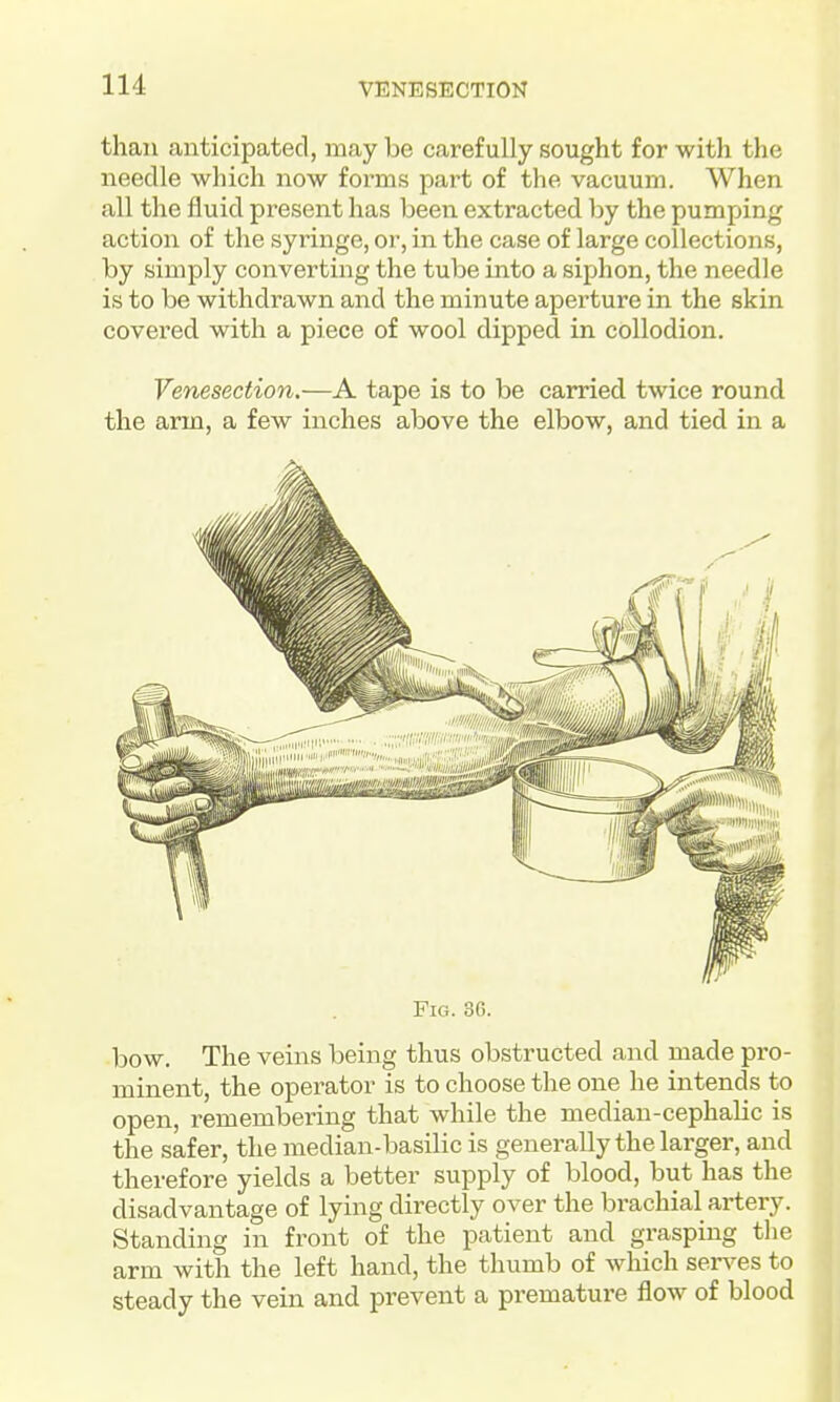 than anticipated, may be carefully sought for with the needle which now forms part of the vacuum. When all the fluid present has been extracted by the pumping action of the syringe, or, in the case of large collections, by simply converting the tube into a siphon, the needle is to be withdrawn and the minute aperture in the skin covered with a piece of wool dipped in collodion. Venesection.—A tape is to be carried twice round the arm, a few inches above the elbow, and tied in a Fig. 8G. bow. The veins being thus obstructed and made pro- minent, the opei-ator is to choose the one he intends to open, remembering that while the median-cephalic is the safer, the median-basilic is generally the larger, and therefore yields a better supply of blood, but has the disadvantage of lying directly over the brachial artery. Standing in front of the patient and grasping the arm with the left hand, the thumb of which senses to steady the vein and prevent a premature flow of blood