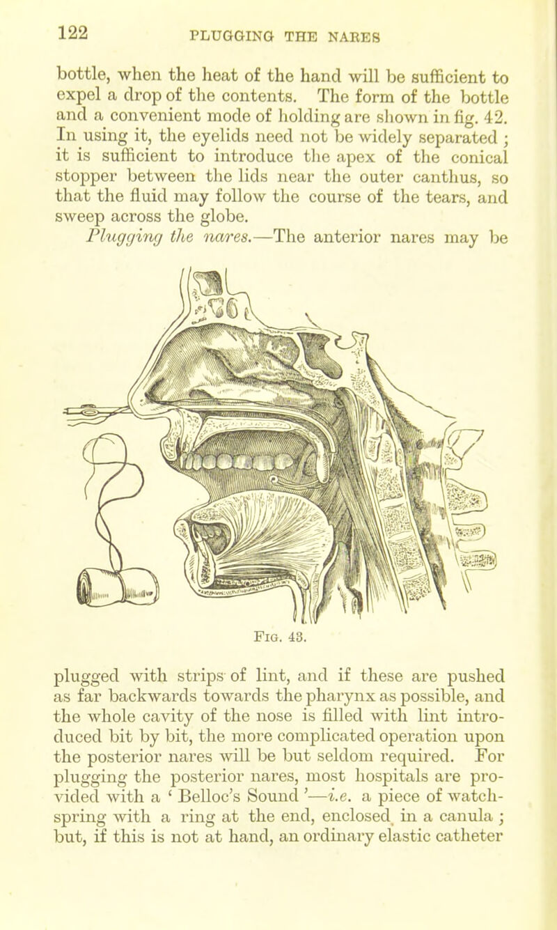PLUGGING THE NAEES bottle, when the heat of the hand will be sufficient to expel a drop of the contents. The form of the bottle and a convenient mode of holding are sliown in fig. 42. In using it, the eyelids need not be widely separated ; it is sufficient to introduce tlie apex of the conical stopper between the lids near the outer canthus, so that the fluid may follow the course of the tears, and sweep across the globe. Flugcjing the nares,—The anterior nares may he Fig. 48. plugged with strips of lint, and if these are pushed as far backwards towards the pharynx as possible, and the whole cavity of the nose is filled with lint intro- duced bit by bit, the more complicated operation upon the posterior nares will be but seldom required. For plugging the posterior nares, most hospitals are pro- vided with a ' Belloc's Sound '—i.e. a piece of watch- spring with a ring at the end, enclosed in a canula ; but, if this is not at hand, an ordinary elastic catheter