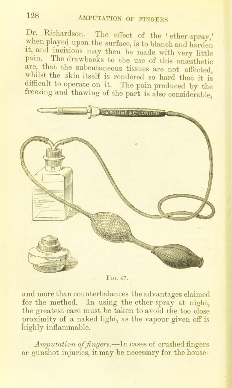 Dr. Richardson. The effect of the 'ether-spray' when played upon the surface, is to blanch and hardeii It, and incisions may then be made with very little pain. The drawbacks to the use of this anajsthetic are, that the subcutaneous tissues are not affected, whilst the skin itself is rendered so hard that it i.s difficult to operate on it. The pain produced by the freezing and thawing of the part is also considerable, Fig. 47. and more than counterbalances the advantages claimed for the method. In using the ether-spray at night, the greatest care must be taken to avoid the too close proximity of a naked light, as the vapour given off is highly inflammable. Amputation of fingers.—In cases of crushed fingers or gunshot injuries, it may be necessary for the house-
