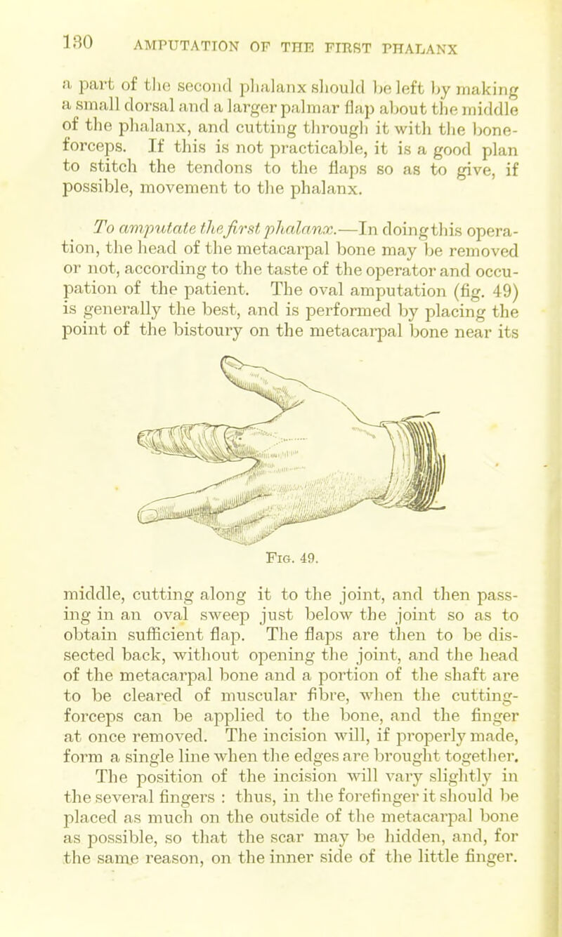 AMPUTATION OP THE PIBST PHALANX a part of tlie second plialaDx sliould ))e left by making a small dorsal and a larger palmar flap about the middle of the phalanx, and cutting througli it with the Ijone- forceps. If this is not practicable, it is a good plan to stitch the tendons to the flaps so as to give, if possible, movement to tlie phalanx. To amputate the first phalanx.—In doing this opera- tion, the head of the metacai'pal bone may be removed or not, according to the taste of the operator and occu- pation of the patient. The oval amputation (fig. 49) is generally the best, and is performed by placing the point of the bistoury on the metacarpal bone near its Fig. 49. middle, cutting along it to the joint, and then pass- ing in an oval sweejD just below the joint so as to obtain sufficient flap. The flaps are then to be dis- sected back, without opening the joint, and the head of the metacarpal bone and a portion of the shaft are to be cleared of muscular fibre, wdien the cutting- forceps can be applied to the bone, and the finger at once removed. The incision will, if jiropei'ly made, form a single line when the edges are brought together. The position of the incision will vary slightly in the several fingers : thus, in the forefinger it should be placed as much on the outside of the metacarpal bone as possible, so that the scar may be liidden, and, for the sarae reason, on the inner side of the little finger.