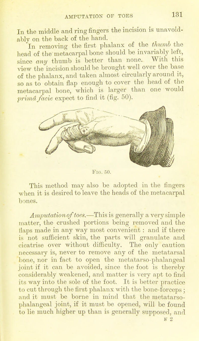 In the middle and ring fin^Grs fcliG incis o ably on the back of the hand. In removino- the first phalanx of the thumb the head of the metacarpal bone should be invariably left, since any thumb is better than none. With this view the incision should be brought well over the base of the phalanx, and taken almost circularly around it, so as to obtain flap enough to cover the head of the metacarpal bone, Avhich is larger than one would prhnd facie expect to find it (fig. 50). Fig. 50. This method may also be adopted in the fingers when it is desired to leave the heads of the metacai'pal bones. Amputation of toes.—This is generally a veiy simple matter, the crushed portions being removed and the flaps made in any way most convenient : and if there is not sufficient skin, the parts will granulate and cicatrise over without difficulty. The only caution necessary is, never to remove any of the metatarsal bone, nor in fact to open the metatarso-phalangeal joint if it can be avoided, since the foot is thereby considerably weakened, and matter is very apt to find its way into tlie sole of the foot. It is better practice to cut through the first phalanx with the bone-foiceps; and it must be borne in mind that the metatarso- phalangeal joint, if it must be opened, will be found to lie much higher up than is genei^ally supposed, and K 2
