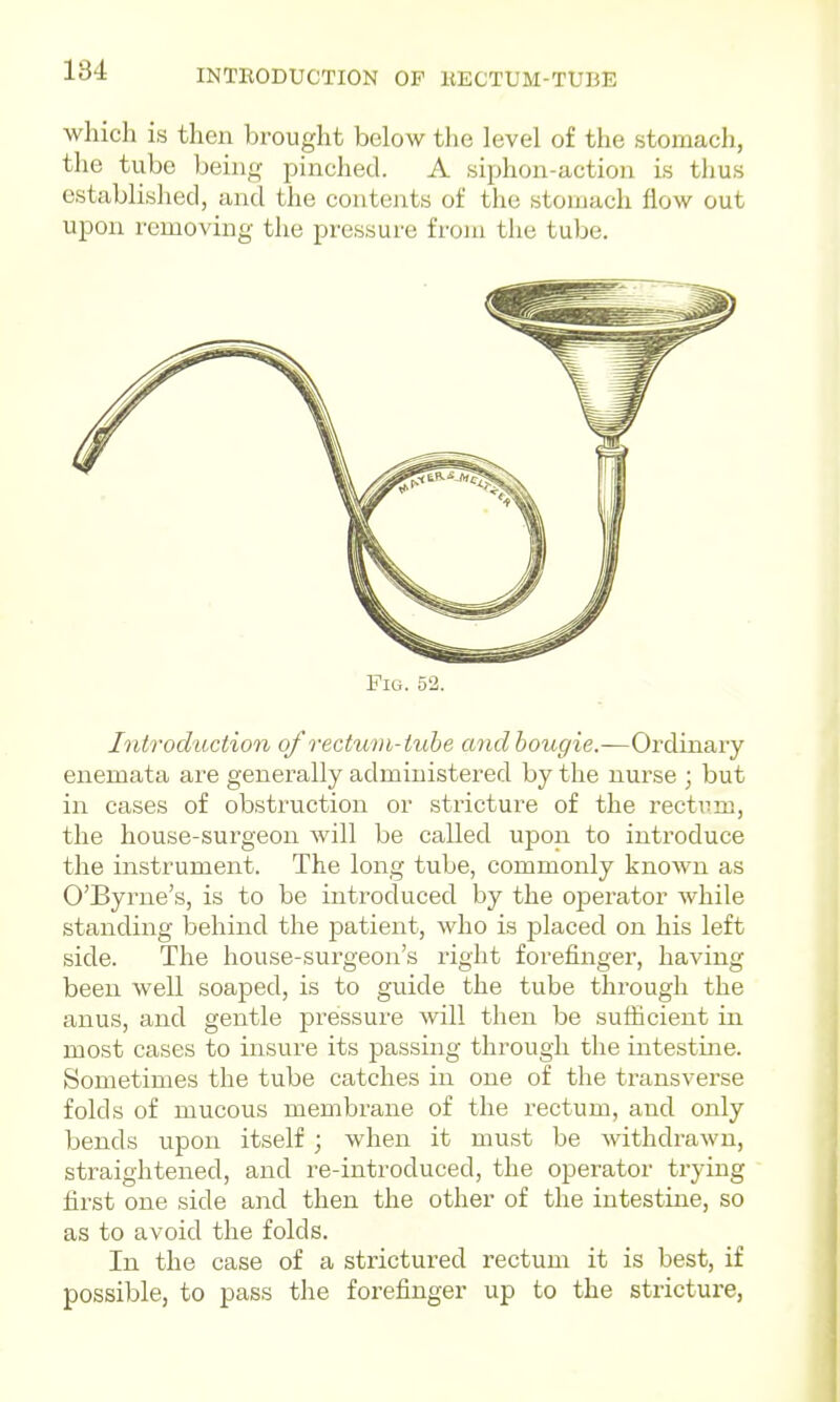 which is then brought below tlie level of the stomach, the tube being pinched. A siphon-action is thus established, and the contents of the stomach flow out upon removing the pressure from the tube. Fiu. 52. Introduction of I'ectum-tube and bougie.—Ordinary enemata are generally administered by the nurse ; but in cases of obstruction or stricture of the rectvm, the house-surgeon will be called upon to introduce the instrument. The long tube, commonly known as O'Byrne's, is to be introduced by the operator while standing behind the patient, who is jDlaced on his left side. The house-surgeon's right forefinger, having been well soaped, is to guide the tube through the anus, and gentle pressure will then be sufficient in most cases to insure its passing through the intestine. Sometimes the tube catches in one of the transverse folds of mucous membrane of the rectum, and only bends upon itself ; when it must be Avithdrawn, straightened, and re-introduced, the operator trying first one side and then the other of the intestine, so as to avoid the folds. In the case of a strictured rectum it is best, if possible, to pass the forefinger up to the stricture.