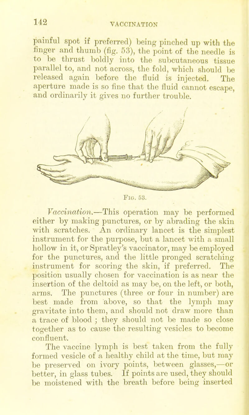 painful spot if preferred) being pinched up with the finger and thumb (fig. 53), tlie point of the needle is to be thrust boldly into the subcutaneous tissue iwallel to, and not across, the fold, whicli should be released again before the fluid is injected. The aperture made is so fine that the fluid cannot escape, and ordinarily it gives no further trouble. Fig. 53. Vaccination.—This operation may be performed either by making punctures, or by abrading the skin Avith scratches. An ordinary lancet is the simplest instrument for the purpose, but a lancet with a small hollow in it, or Spratley's vaccinator, may be employed for the punctures, and the little jDronged scratching instrument for scoring the skin, if j^referred. The position usually chosen for vaccination is as near the insertion of the deltoid as may be, on the left, or both, arms. The punctures (three or four in number) are best made from above, so that the lymph may gravitate into them, and should not draw more than a trace of blood ; they should not be made so close together as to cause the resulting vesicles to become confluent. The vaccine lymph is best taken from the fully formed vesicle of a healthy child at the time, but may be preserved on ivory points, between glasses,—or better, in glass tubes. If points are used, they should be moistened with the breath before being inserted