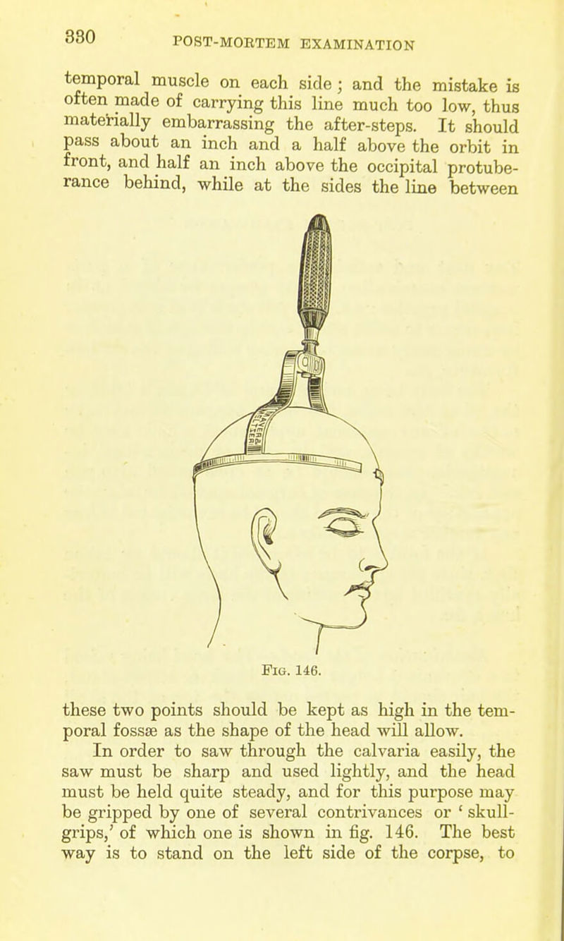 POST-MOETEM EXAMINATION temporal muscle on each side; and the mistake is often made of carrying this line much too low, thus materially embarrassing the after-steps. It should pass about an inch and a half above the orbit in front, and half an inch above the occipital protube- rance behind, while at the sides the line between Fig. 146. these two points should be kept as high in the tem- poral fossae as the shape of the head will allow. In order to saw through the calvaria easily, the saw must be sharp and used lightly, and the head must be held quite steady, and for this purpose may be gripped by one of several contrivances or ' skull- grips,' of which one is shown in fig. 146. The best way is to stand on the left side of the corpse, to