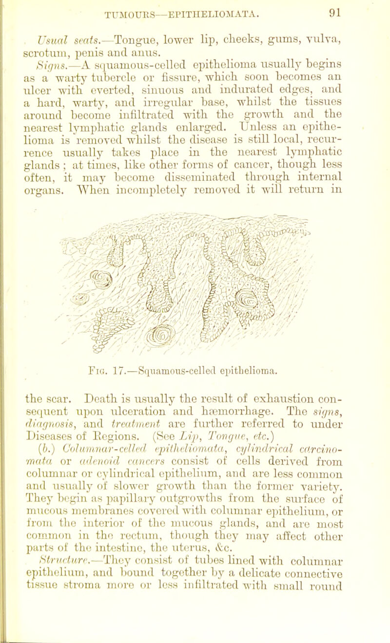 TUJIOUHS— Usual scats.—Tongue, lower lip, clieeks, gums, Yulva, scrotum, penis and anus. Signs.—A squamous-celled epithelioma usually begins as a warty tubercle or fissure, which soon becomes an ulcer with everted, sinuous and indurated edges, and a hard, warty, and irregular base, whilst the tissues aroirad become infiltrated with the growth and_ the nearest lymphatic glands enlarged. Unless an epithe- lioma is removed whilst the disease is still local, reciu-- rence usually takes place in the nearest lymphatic glands ; at times, like other forms of cancer, though less often, it may become disseminated through internal organs. When incompletely removed it will return in Fig. 17.—Squamous-celled epitbelioraa. the scar. Death is usually the result of exhaustion con- sequent upon ulceration and hfemorrhage. The signs, diagnosis, and treatment are further referred to under Diseases of Eegions. (See Liji, Tongue, etc.) (6.) Columnar-celled epilhelidmafa, cyJindrieal cc.rcino- mata or adenoid cancers consist of cells derived from columnar or cylindrical epithelium, and are less common and usually of slower growth than the former variety. They begin as papillary outgrowths from the surface of mucous membranes covered with columnar epithelium, or froiu the interior of the mucous glands, and ai'o most common in the rectum, though they may affect other parts of the intestine, the ut(;rus, &c. Structure.—They consist of tubes lined with columnar epithelium, and bound together by a delicate connective tissue stroma more or less infiltrated with small round