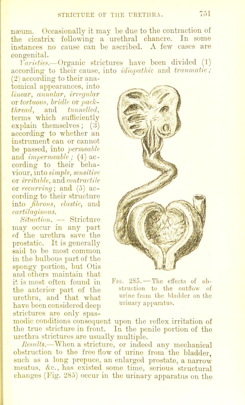 najiim. Occasiouallj^ it may be due to tlie contraction of the cicatrix following a urethral chancre. In some instances no cause can be ascribed. A few cases are congenital. ]'arieiie$.—Organic strictures have been divided (1) according to their cause, into idiojiat/ric and iranmatic ; (2) according to their ana- tomical appearances, into linear, annular, irregular or tortuous, hridh' or pack- thread, and tunnelled, terms which sufficiently explain themselves; (3) according to whether an instrument can or cannot be passed, into permeuhJe and impermeahh'; (4) ac- cording to their beha- viour, into simple, sensitive or irritalde, and r.ontradile or recurring; and (.5) ac- cording to their structure into fibrous, elastic, and eurtilaginuus. Situ(itio7i. — Stricture may occur in any part nf the urethra save the prostatic. It is generally said to be most common in the bulbous part of the spongj^ portion, but Otis and others maintain that it is most often found in the anterior part of the urethra, and that what have been considered deep strictui'es are only spas- modic conditions consequent upon the reflex irritation of the true stricture in front. In the penile portion of the urethra strictui'es are usually multiple. JlesuUs.—When a stricture, or indeed any mechanical obstruction to the free flow of urine from the bladder, such as a long prepuce, an enlarged prostate, a narrow meatus, &c., has existed some time, serious structural changes (Fig. 28.5) occur in the luinary ajiparatus on the Fro. 285. —The cflects of ob- struction to tlie outflow of urine from tlic bladder on the urinary apparatus.