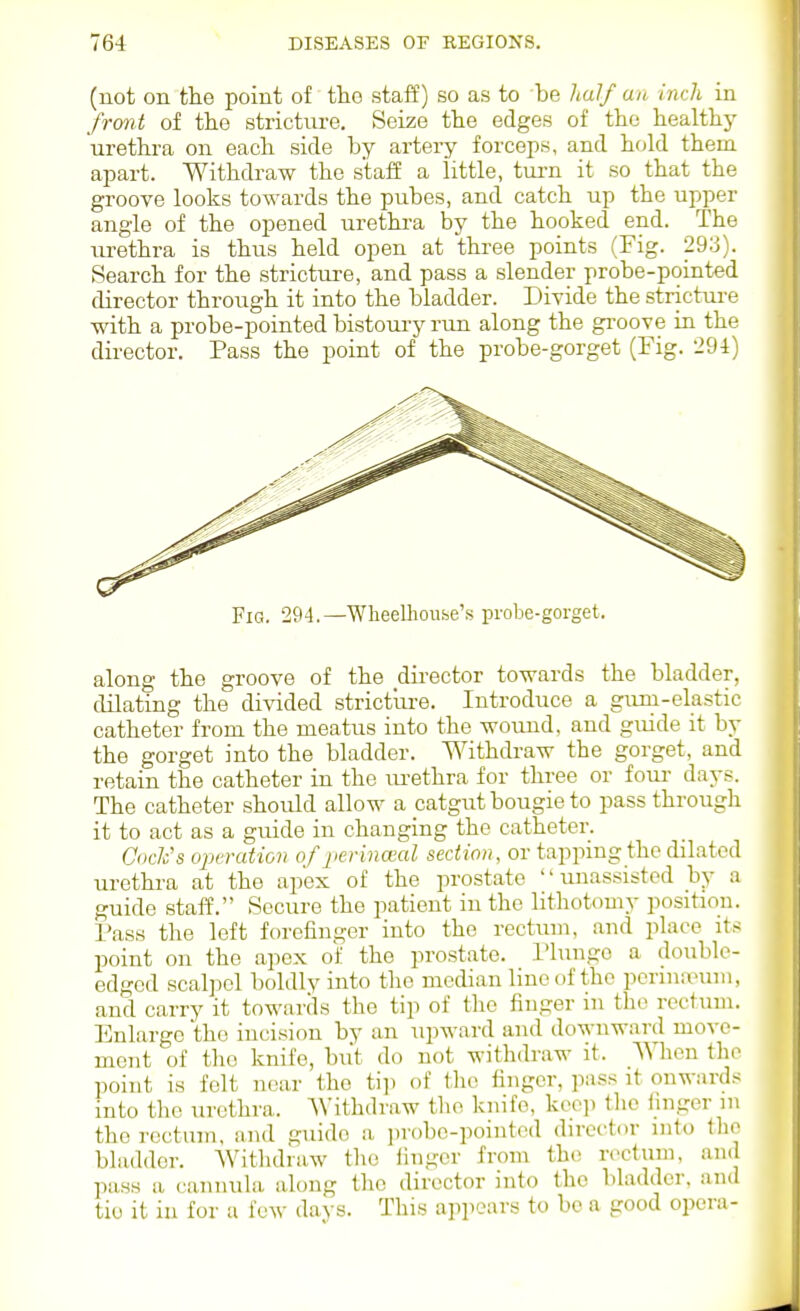 (not on the point of tho staff) so as to be half an inch in frmit of the stricture. Seize the edges of the healthy urethi-a on each side by artery forceps, and hold them apart. Withdraw the staff a little, tui-n it so that the groove looks towards the pubes, and catch up the upper angle of the opened urethra by the hooked end. The urethra is thus held open at three points (Fig. 293). Search for the stricture, and pass a slender probe-pointed director through it into the bladder. Divide the strictui-e with a probe-pointed bistoury run along the gi-oove in the director. Pass the point of the probe-gorget (Fig. 29i) Fig. 294.—Wheelhoiise's probe-gorget. along the groove of the director towards the bladder, dilating the divided stricture. Introduce a giun-elastic catheter from the meatus into the wound, and guide it by the gorget into the bladder. Withdraw the gorget, and retain the catheter in the lU'ethra for three or fom- days. The catheter should allow a catgut bougie to pass through it to act as a guide in changing the catheter. Cock's operation of pcrinoial section, or tapping the dilated urethra at the apex of the prostate  unassi:jted by a guide staff. Secure the patient in the lithotomy position. Pass the left forefinger into the rectum, and place it.-; point on the apex of the prostate. I'luugo a double- edged scalpel boldly into tlio median line of the porinanim, and carry it toward.s the tip of tlio finger in t]i<^ rectum. Enlarge the incision by an upward and downward move- ment of the knife, but do not withdraw it. When the point is felt near the tip of the finger, pass it onwards into the urethra. Withdraw the knife, kco]) the linger in the rectum, and guide a jirobc-pointod director into the bladder. Witlidraw the iingcr from tho. rcctuni, aiK pass a cannula along the director into the bladder, and tie it in for a few da^ s. This appears to bo a good opera-