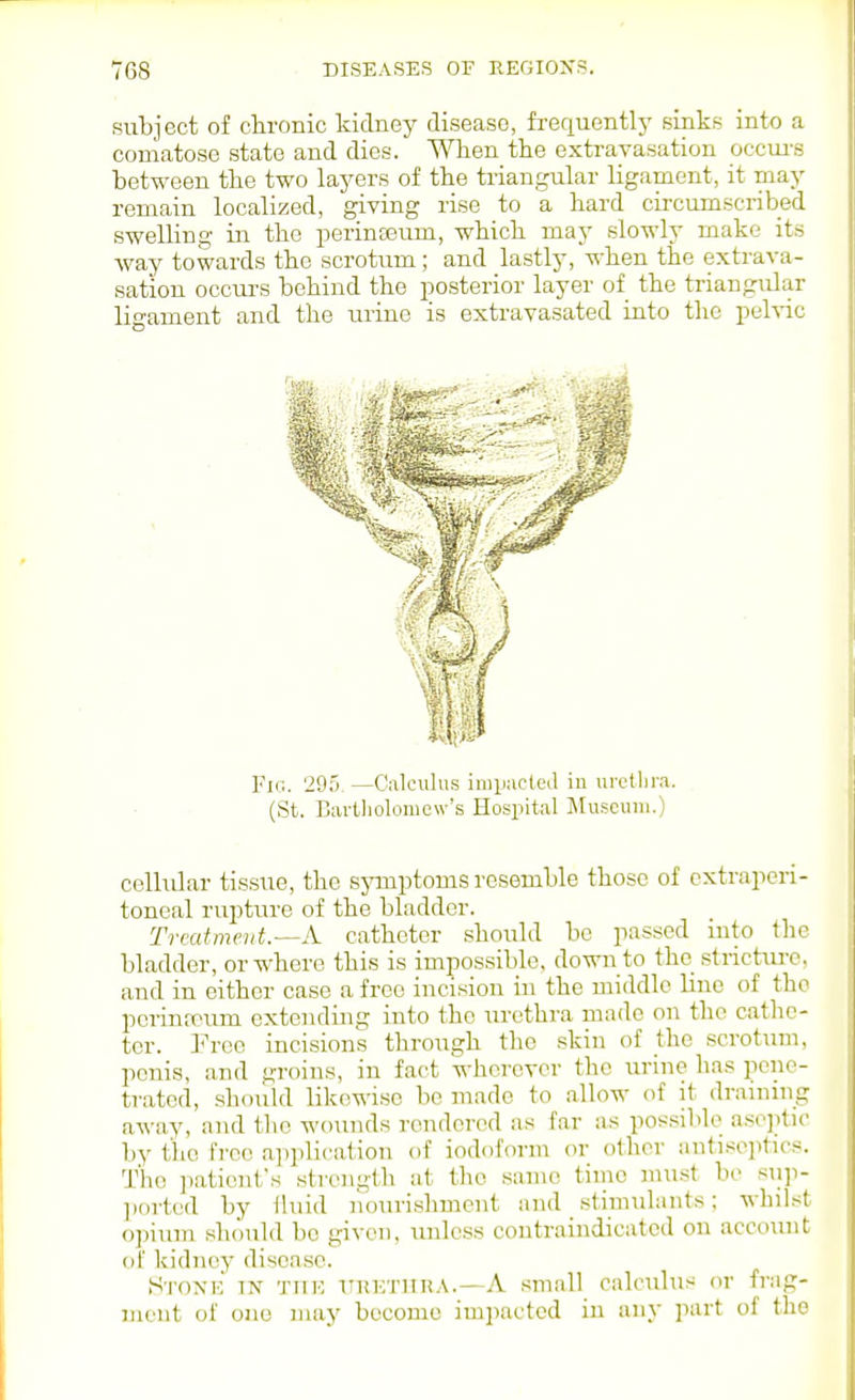 subject of chronic kidney disease, frequently sinks into a comatose state and dies. When the extravasation occm-s between the two layers of the triangular ligament, it may remain localized, giving rise to a hard circumscnbed swelling in the perineeum, which may slowly make its Avay towards the scrotum; and lastly, when the extrava- sation occui's behind the posterior layer of the triangular ligament and the mine is extravasated into the pelvic Fig. 295. —C;\lciilus impacted iu urctlira. (St. Bai-tlioloniew's Hospital Museum.) cellular tis.sue, the symptoms resemble those of extraperi- toneal rupture of the bladder. Trmtmeut.--A catheter should be passed nito the bladder, or where this is impossible, down to the stricture, and in either case a free incision in the middle line of the pcrinttum extending into the urethra made on the cathe- ter. Free incisions through the skin of the scrotum, penis, and -roius, in fact wherever the urine has pene- trated, .should likewise be made to allow of it dranung away, and tlie wounds rendered as far as possible asojitic l)y the free a]-»plication of iodoform or other anti.se]itu-s. 'J'he ]iatient's strength at the same time must be siiji- liorted by iluid nourishment and .stimulants; whilst ojiium should be given, unless contraindicated on account (if kidney disease. SroNK IN TTiE ITRKTHR.V.—A .small culculus or friig- nieut of one may become impacted in any ]iart of the