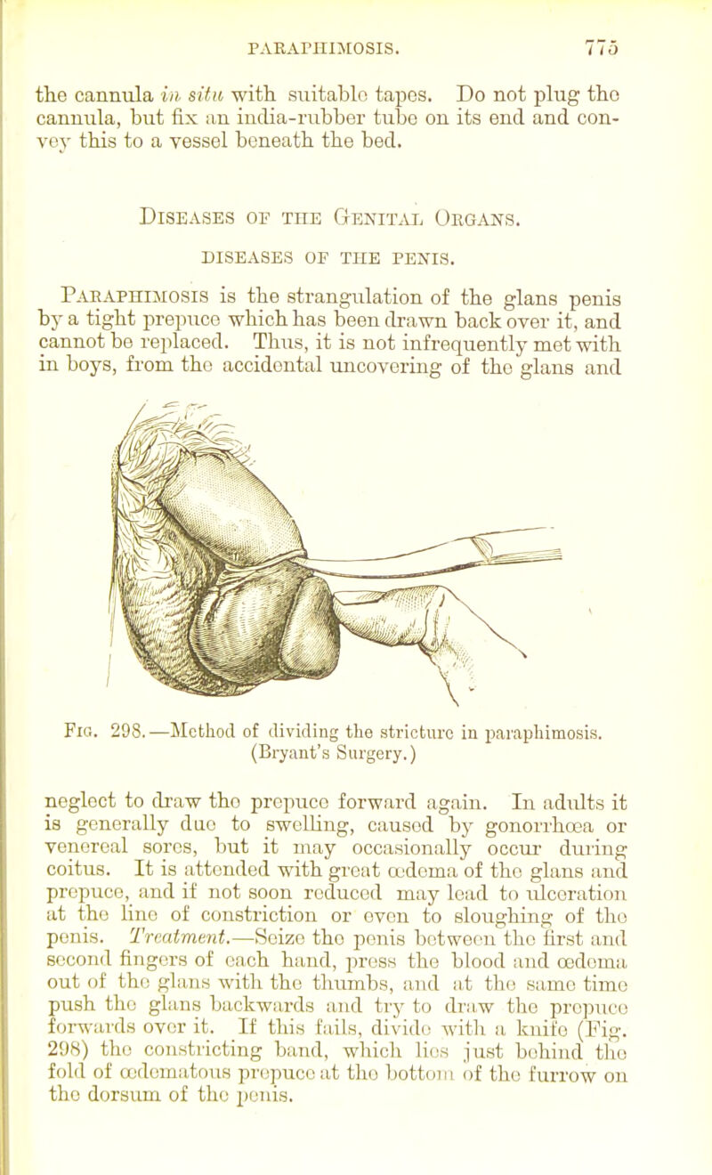 the cannula in situ with suitable tapes. Do not plug tho cannula, but fix an india-rubber tube on its end and con- vey this to a vessel beneath the bed. Diseases of the Genit.vi. Organs. diseases of tub penis. Pahaphimosis is the strangulation of the glans penis bj' a tight prepuce which has been di-awn back over it, and cannot be replaced. Thus, it is not infrequently met with in boys, from the accidental ujicovoring of the glans and Fio. 298.—Method of dividing the stricture in paraphimosis. (Bryant's Surgery.) neglect to di-aw tho prepuce forward again. In adults it is generally due to swelling, caused by gonorihoea or venereal sores, but it may occasionally occur- during coitus. It is attended with great oedema of tho glans and prepuce, and if not soon reduced may lead to ulceration at the line of constriction or oven to sloughing of tho penis. Treatment.—Seize tho penis between the iirst and second fingers of each hand, press the blood and oedema out of the glans with tho thumbs, and at the same time push the glans backwards and try to dra,w the pre]3uco forwards over it. If this fails, divide with a knife (Fig. 298) the constricting band, which lies just behind the fold of ccdematous prepuce at tho bottom of the furrow on tho dorsum of the penis.