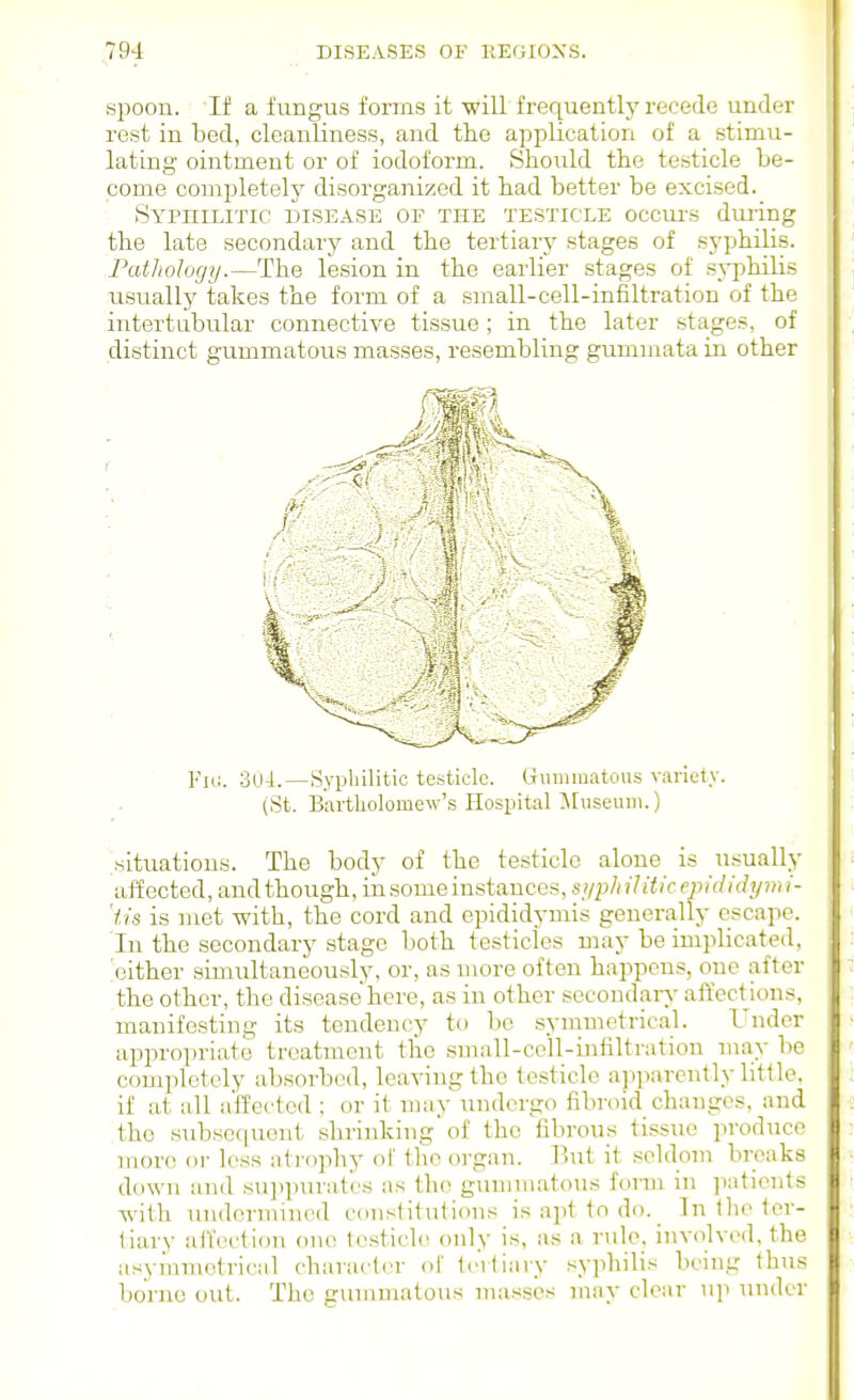spoon. If a fungus forms it will frequently recede under rest in bed, cleanliness, and the application of a stimu- lating ointment or of iodoform. Should the testicle be- come completely disorganized it had better be excised. Syphilitic disease of the testicle occurs during the late secondary and the tertiary stages of syphilis. Fatliology.—The lesion in the earlier stages of syphilis usually takes the form of a small-cell-infiltration of the intertubular connective tissue; in the later stages, of distinct gummatous masses, resembling gummata in other Fid. 3U4.—Syphilitic testicle. Gummatous variety. (St. Bartholomew's Hospital ^Museum.) situations. The body of the testicle alone is usually affected, and though, in some instances, sjiph ilitic cpididijm i- 'iis is met with, the cord and epididymis generally escape. In the secondary stage both testicles may be implicated, Neither simultaneously, or, as more often happens, one after the other, the disease here, as in other secondary affections, manifesting its tendency to be symmetrical. Under apin-opriate treatment tlio small-co'll-infiltration may be completely absorbed, leaving the testicle a])parcntly little, if at all affected ; or it may undergo fibroid changes, and the subsequent shrinking of the fibrous tissue produce more oi- loss atrophy of the organ. But it seldoni breaks down and suiipurat'cs as the guniniatous form in patients with undermined coiistilutioiis is apt to do. In Iho ter- tiary alfection one tostich^ only is, as a rule, involved, the asymmetrical character of tertiary syjihilis being thus borne out. The g\nnmatous masses may clear up under