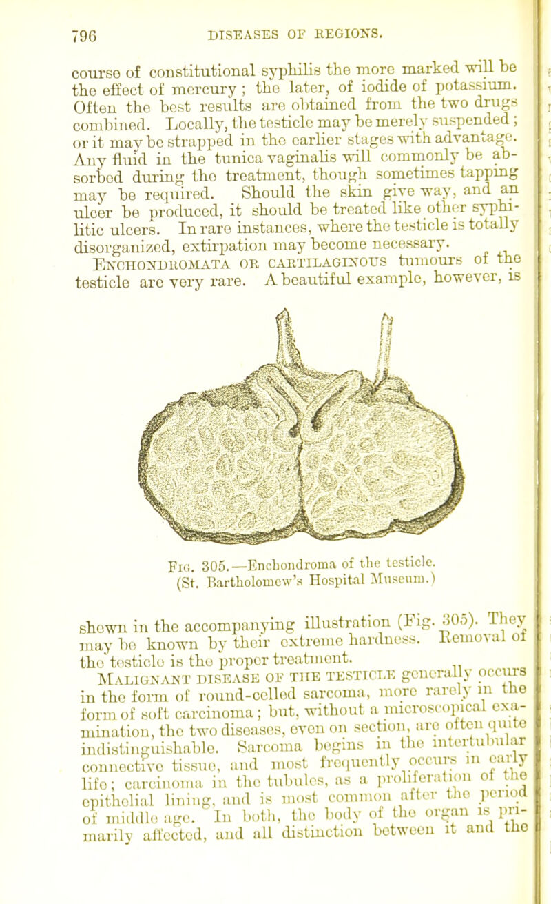 course of constitutional sypMlis tlie more marked vill be the effect of mercury ; the later, of iodide of potassium. Often the best results are o1)tained from the two drugs combined. Locally, the testicle may be merely suspended ; or it may be strapped in the earlier stages with advantage. Any fluid in the tunica vaginalis will commonly be ab- sorbed during the treatment, though sometimes tapping may be required. Should the skin give way, and an ulcer be produced, it should be treated like other syi^hi litic ulcers. In rare instances, where the testicle is totally disorganized, extirpation may become necessary. Enchondromata ok CARTiLAGi>-ors tumouTs of the testicle are very rare. Abeautifid example, however, is Fig. 305.—Encbondroma of tlie testicle. (St. Bartliolomow'.s Hospital :Muscuni.) shewn in the accompanying iUustration (Fig. SOo). They may bo known by their extreme hardness. Keuioval ot the testicle is the proper treatment. Malignant disease of the testicle generally occiirs in the form of round-celled sarcoma, more rarely m the form of soft carcinoma; but, without a microscopical exa- mination, the two diseases, even on section, arc oiteii quite indistinguishable. Sarcoma begins in the mtcrtubular connoctfvc tissue, and most frequently occurs m early life; carcinoma in the tubules, as a proliferation of the epithelial lining, and is most common after the period of middle ago. In both, the body of the organ is^ pri- marily affected, and all distinction between it and the
