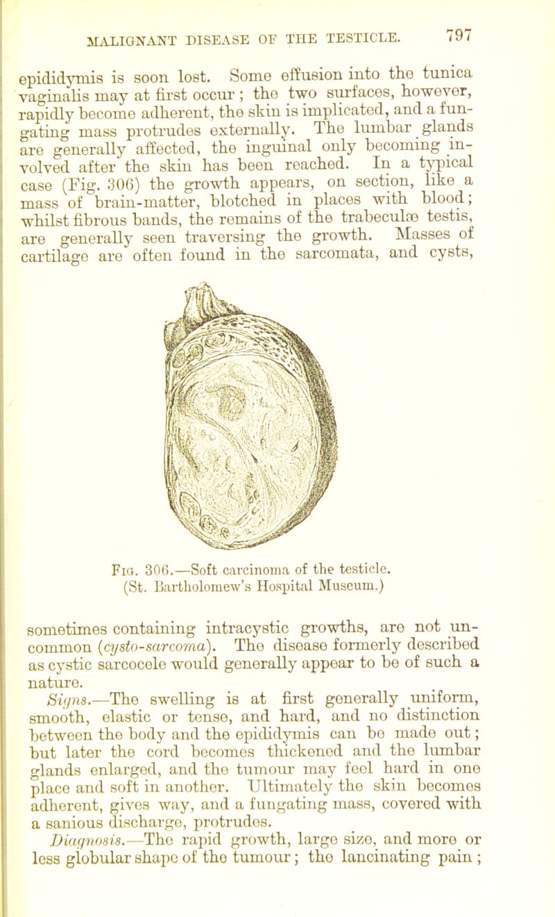 epididymis is soon lost. Some effusion into the tunica vaginalis may at first occui-; the two sm-faces, however, rapidly become adherent, the skin is implicated, and a fun- gating mass protrudes externally. The lumbar glands are generally affected, the inguinal only becommg in- volved after the skin has been reached. In a typical case (Fig. 306) the growth appears, on section, like a mass of brain-matter, blotched in places with blood; whilst fibrous bands, the remains of the trabeculaj testis, are generally seen traversing the growth. Masses of cartilage are often found in the sarcomata, and cysts, FiQ. 306.—Soft carcinoma of the testicle. (St. Bartholomew's Hospital Museum.) sometimes contaiuing intracystic growths, are not _im- common (cysto-sarcoma). The disease formerly described as cystic sarcocele would generally appear to be of such a nature. Signs.—The swelling is at first generally unifoiTu, smooth, elastic or tense, and hard, and no distinction between the body and the epididymis can be made out; but later the cord becomes thickened and the lumbar glands enlarged, and the tumour may feel hard in one place and soft in another. Ultimately the skin becomes adherent, gives way, and a fungating mass, covered with a sanious discharge, protrudes. iJiafpiosis.—The rapid growth, largo size, and more or less globular shape of the tumour; the lancinating pain;
