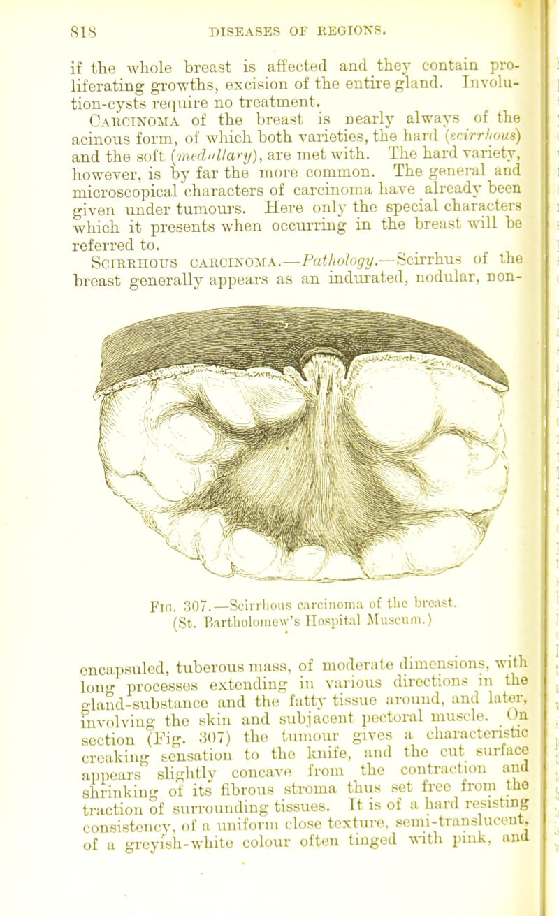 if the whole breast is affected and they contain pro- liferating growths, excision of the entire gland. Involu- tion-cysts reqmre no treatment. Carcinoma of the breast is nearly always of the acinous form, of which both varieties, the hard {erJrrhous) and the soft {mvd'dlary), are met with. The hard variety, however, is by far the more common. The general and microscopical characters of carcinoma have already been given under tumom-s. Here only the special characters which it presents when occurring in the breast will be referred to. Scirrhous cARCiNOiiA.—Pa</io%?/.—Scirrhus of the breast generally appears as an indurated, nodular, non- (St. Bartholoiiie\v'.s Hospital Museum.) encapsulcd, tuberous mass, of moderate dimensions, with Ion- processes extending iu various directions m the gland-substance and the fatty tissue around, and later, involving the skin and subjacent pectoral muscle. On section (Fig. 307) the tumour gives a characteristic creaking sensation to the knife, and the cut surface appears sliglitly concave from the contraction and shrinking of its fibrous stroma thus set free from the traction of surrounding tissues. It is of a hard resisting consistency, of a uniform close texture, semi-trans ucent. of a greyi'sh-whito colour often tmged with pink, and