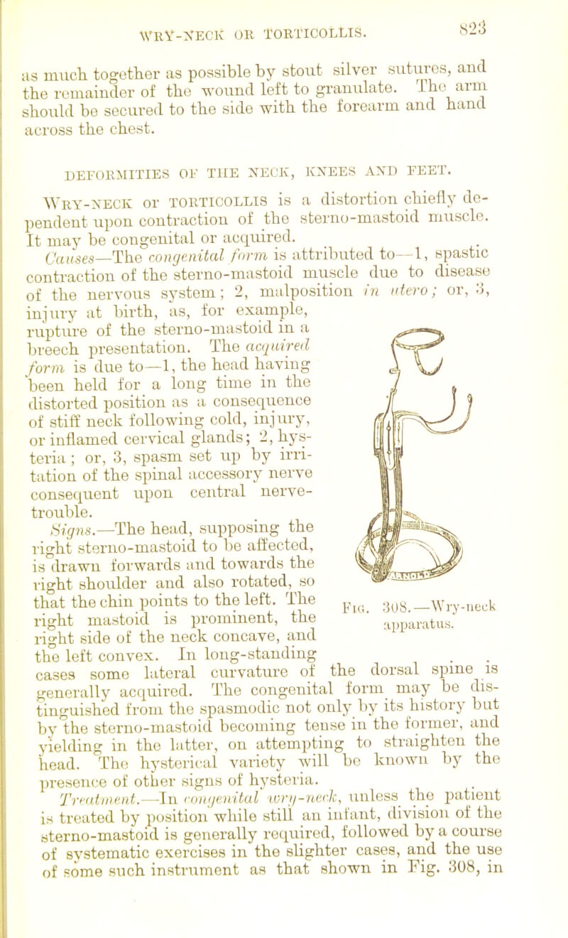 WRY-NECK OR TORTICOLLIS. as muck together as possible by stout silver sutures, and the remainder of the wound left to granulate, ihe arm should be secured to the side with the forearm and hand across the chest. DEFORMITIES OE TUB NECK, IvXEES AND EEET. Wry-neck or torticollis is a distortion chiefly de- pendent upon contraction of the sterno-mastoid muscle. It may be congenital or acquired. Causes—The congenital form is attributed to— 1, spastic contraction of the sterno-mastoid muscle due to disea.se of the nervous system; 2, malposition in ittero; or, ;J, injury at birth, as, for example, rupture of the sterno-mastoid in a breech presentation. The acquired form is due to—1, the head having been held for a long time in the distorted position as a consequence of stiff neck following cold, injury, or inflamed cervical glands; 2, hys- teria ; or, 3, spasm set up by irri- tation of the spinal accessory nerve consecpent upon central nerve- trouble. Signs.—The head, supposing the right sterno-mastoid to be affected, is drawn forwards and towards the right shoulder and also rotated, so that the chin points to the left. The .3^,^ _w,y.„eck right mastoid is prominent, the apparatus.' right side of the neck concave, and the left convex. In long-standing cases some lateral curvature of the dorsal spine is generally acquired. The congenital form may be dis- tinguished from the spasmodic not only by its history but by the sterno-mastoid becoming tense in the former, and yielding in the latter, on attempting to straighten the head. The hysterical variety will bo known by the presence of other signs of hysteria. Treatment.—In congenital wrij-neck, unless the patient is treated by position while still an infant, division of the sterno-mastoid is generally required, followed by a course of systematic exercises in the slighter cases, and the use of some such instrument as that shown in Fig. 308, in