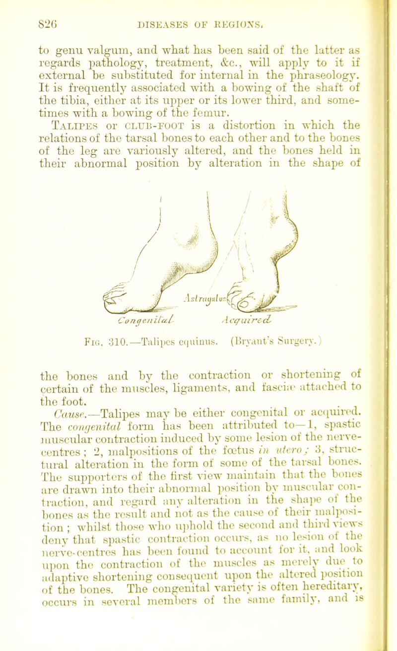 to genu valgum, and what has been said of the latter as regards i^athology, treatment, &c., will apply to it if external be substituted for internal in the phraseology. It is frequently associated with a bowing of the shaft of the tibia, either at its upper or its lower thii'd, and some- times with a bowing of the femur. Talipes or club-foot is a distortion in which the relations of the tarsal bones to each other and to the bones of the leg are variously altered, and the bones held in their abnormal j^osition by alteration in the shape of Concie.iiiia.l- Acc/ui7'e<i Fig. 310.—Talipes cquiuiis. (BrViiut's .Surgerv.) the bones and by the contraction or shortening of certain of the muscles, ligaments, and fasciu' attached to the foot. Causp.—Talipes may be either congenital or acquired. The congenital form has been attributed to—1, spastic muscular contraction induced by some lesion of the nerve- centres ; 2, malpositions of the foetus in ufero; 3, struc- tural alteration in the form of some of the tarsal bones. The supporters of the first view maintnin that the bones are drawn into their abnormal jiosition by nuisciilar con- traction, and regard any alteration in the sha])e of the bones as the result and not as the cause of their nialjwsi- tion ; whilst those who u])hold the second and third views deny that spastic contraction occin-s, as no lesion of the iiorve-centres has been found to account for it, :ind look upon the contraction of the muscles as merely duo to adaptive shortening consequent upon the altered position of the bones. The congenital variety is often hereditary, occurs in several members of the sinne family, and is