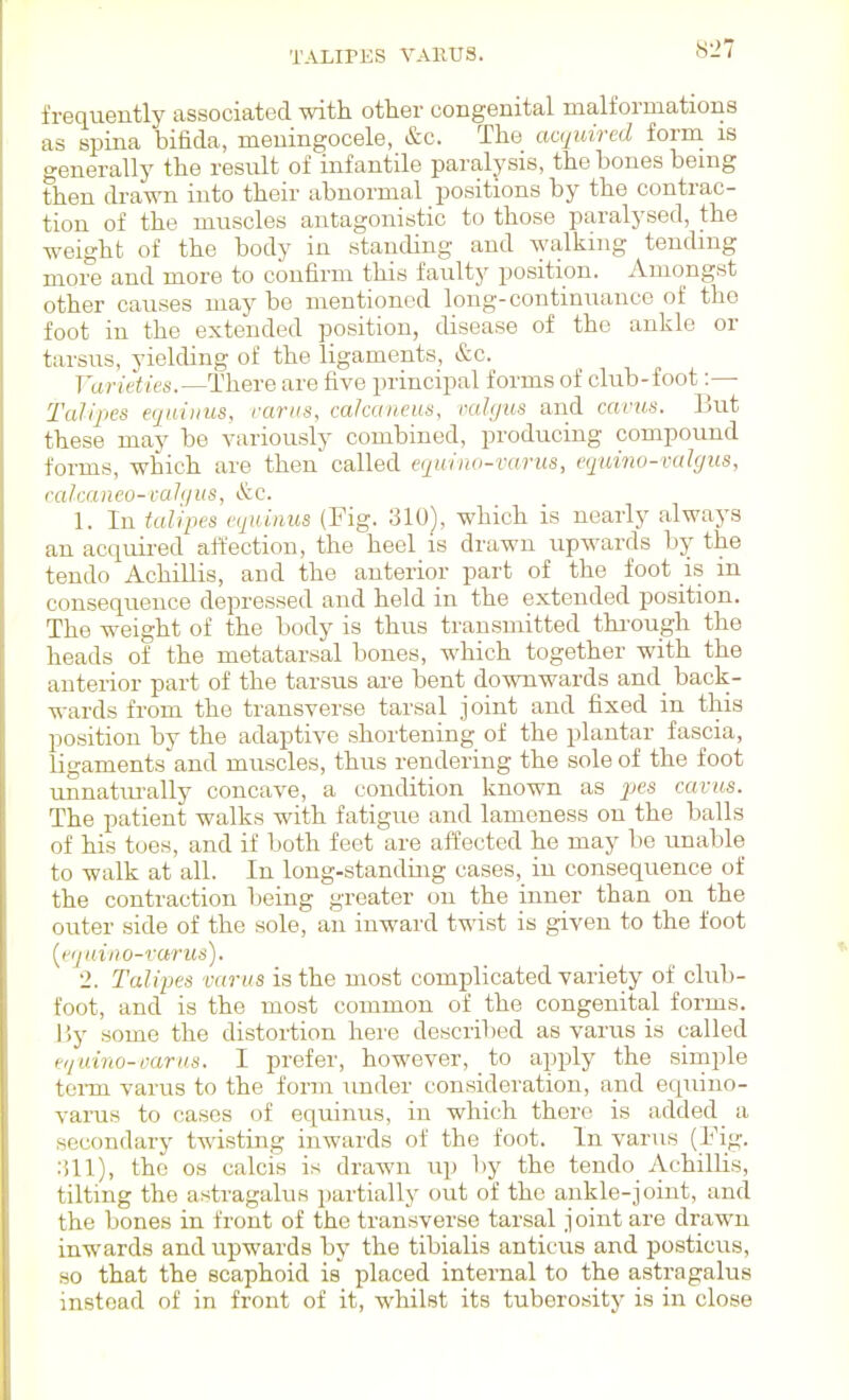TALIPES VARUS. frequently associated with other congenital malformations as spina bifida, meningocele, &c. The acquired forna is generally the result of infantile paralysis, the bones being then drawn into their abnormal positions by the contrac- tion of the muscles antagonistic to those paralysed, the weight of the body in standing and walking tending more and more to confirm this faulty position. Amongst other causes maybe mentioned long-continuance of the foot in the extended position, disease of the ankle or tarsus, yielding of the ligaments, &c. Varieties.—There are five principal forms of club-foot :— Talipes equiuus, rarus, calcaneus, ral(/us and cants. But these may be variou-sly combined, producing compound forms, which are then called equiiw-varus, equino-valgus, calcaneo-vaJqus, &c. 1. In talipes cqxinus (Fig. 310), which is nearly always an acquii-ed affection, the heel is drawn upwards by the tendo Achillis, and the anterior part of the foot is m consequence depressed and held in the extended position. The weight of the body is thus transmitted thi-ough the heads of the metatarsal bones, which together with the anterior part of the tarsus are bent downwards and_ back- wards from the transverse tarsal joint and fixed in this position by the adaptive shortening of the plantar fascia, Ligaments and muscles, thus rendering the sole of the foot unnatiuallj^ concave, a condition known as jxs cavus. The patient walks with fatigue and lameness on the balls of his toes, and if both feet are affected he may be unable to walk at all. In long-standing cases, in consequence of the contraction being greater on the inner than on the outer side of the sole, an inward twist is given to the foot [>'(juii'io-vurus). 2. Talipes varus is the most complicated variety of club- foot, and is the most common of the congenital forms. 15y some the distortion here described as varus is called ei/ui7io-varus. I prefer, however, to apply the simple tei-m varus to the form under consideration, and equino- varus to cases of equinus, in which there is added a secondary twisting inwards of the foot. In varus (Fig. .'ill), the OS calcis is drawn up by the tendo AchilUs, tilting the astragalus partially out of the ankle-joint, and the bones in front of the transverse tarsal j oint are drawn inwards and upwards by the tibialis anticus and posticus, so that the scaphoid is placed internal to the astragalus instead of in front of it, whilst its tuberosity is in close