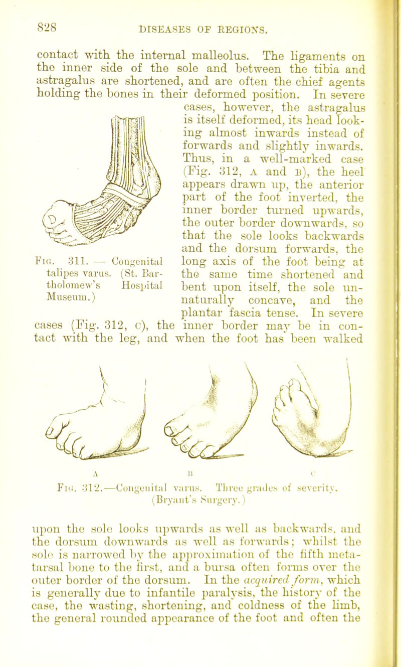 contact with, the internal malleolus. The ligaments on the inner side of the sole and between the tibia and astragalus are shortened, and are often the chief agents holding the bones in their deformed position. In severe cases, however, the astragalus is itself deformed, its head look- ing almost inwards instead of forwards and slightly inwards. Thus, in a well-marked case (Fig. ;jl2, A and b), the heel ajjpears drawn up, the anterior part of the foot inverted, the inner border tm-ned upwards, the outer border downwards, so that the sole looks backwards and the dorsum forwards, the long axis of the foot being at the same time shortened and bent upon itself, the sole un- naturally concave, and the plantar fascia tense. In severe cases (Fig. 312, c), the inner border may be in con- tact with the leg, and when the foot has been walked A 11 (• Fi'i. ■'A2.—C'oii,;,'uiii1al v;irus. Tlii'ce grailL's of severity. (Bry.-iiit's Snryery.') upon the sole looks upwards as well as backwards, and the dorsum downwards as well as forwards; whilst the solo is uarroAVod by the apiiroximation of the fifth meta- tai'sal bone to the first, and a bursa often forms over the outer border of the dorsum. In the dcqiiired form, which is generally due to infantile paralysis, the history of the case, the wasting, shortening, and coldness of the limb, the general rounded appearance of the foot and often the Fig. 311. — Coujjenital talipes varus. (St. Bar- tholomew's Ho.spital Museum.)