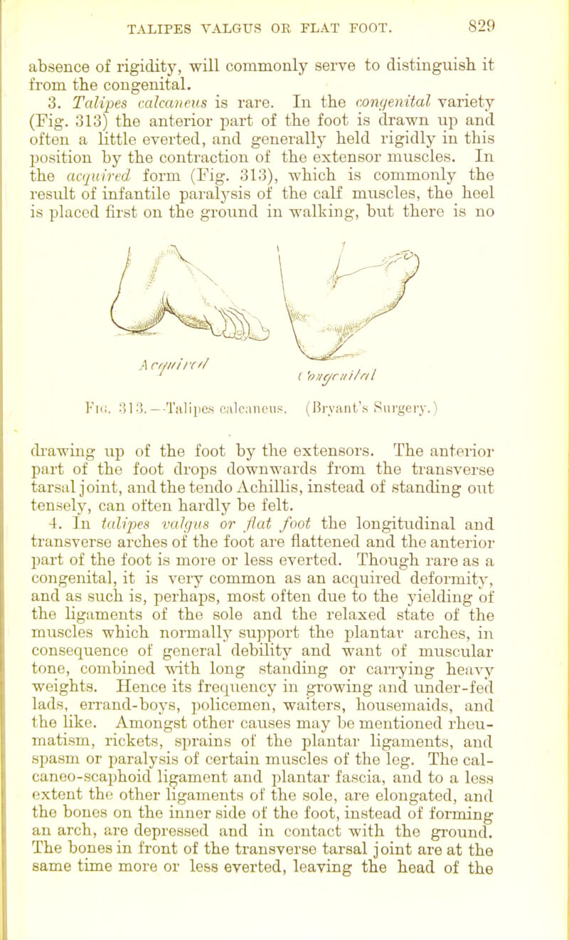 absence of rigidity, will commonly serve to distinguish it from the congenital. 3. Talipes calcaneus is rare. In the congenital variety (Fig. 313) the anterior jDart of the foot is drawn up and often a little everted, and generally held rigidly in this position by the contraction of the extensor muscles. In the acquired form (Fig. 313), which is commonly the result of infantile paralysis of the calf muscles, the heel is placed first on the ground in walking, but there is no Fii;. nio.—-Talipes calcancuf:. (Bryant's Sui'gery.') drawing up of the foot by the extensors. The anterior part of the foot drops downwards from the transverse tarsal joint, and the tendo Achillis, instead of standing out tensely, can often hardly be felt. 4. In talipes valgus or flat foot the longitudinal and transverse arches of the foot are flattened and the anterior part of the foot is more or less everted. Though rare as a congenital, it is very common as an acquired deformity, and as such is, perhaps, most often due to the yieldiiig of the ligaments of the sole and the relaxed state of the muscles which normally support the plantar arches, in consequence of general debility and want of muscular tone, combined with long standing or carrying heavy weights. Hence its frequency in growing and under-fed lads, errand-boys, policemen, waiters, housemaids, and the like. Amongst other causes may be mentioned rheu- matism, rickets, sprains of the plantar ligaments, and sj^asm or paralysis of certain muscles of the leg. The cal- caneo-scaphoid ligament and j^lantar fascia, and to a less extent the other ligaments of the sole, are elongated, and the bones on the inner side of the foot, instead of forming an arch, are depressed and in contact with the gi-ound. The bones in front of the transverse tarsal j oint are at the same time more or less everted, leaving the head of the