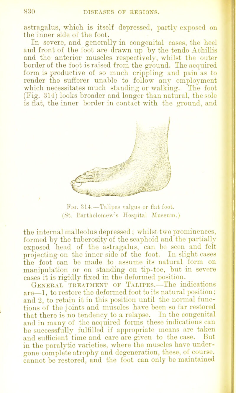 astragalus, which is itself depressod, partly exposed on the inner side of the foot. In severe, and generally in congenital cases, the heel and front of the foot are drawn up by the tendo Achilli.s and the anterior muscles respectively, whilst the outer border of the foot is raised from the ground. The acquired form is productive of so much crippling and pain as to render the sufferer unable to follow any employment which necessitates much standing or walking. The foot (Fig. 314) looks broader and longer than natural, the sole is flat, the inner border in contact with the gi'ound, and Fig. .314.—T;iliiJUf; valgus or flat foot. (St. Bartholoiuew's Ho.spital j\[useuiii.) the internal malleolus dei^ressed ; whilst two prominences, formed by the tubero.sity of the scaphoid and the partially exposed head of the astragalu.-^, can be seen and felt pi'ojecting on the inner side of the foot. In slight cases the foot can be made to assume its natural form on manipulation or on standing on tip-toe, but in severe cases it is rigidly fixed in the deformed po.'^ition. General treatment of Talipes.—The indications are—1, to restore the deformed foot to its natural position: and 2, to retain it in this position until the normal func- tions of the joints and nuiscles have been so far restored that there is'no tendency to a relapse. In the congenital and in many of the accjuircd forms these indications can bo successfully fulfilled if approjiriate means are taken and sufiicient time and care are given to the case. But in the paralytic varieties, where the muscles have \inder- gono complete atrophy and degeneration, those, of course, cannot bo restored, and the foot can only be maintained