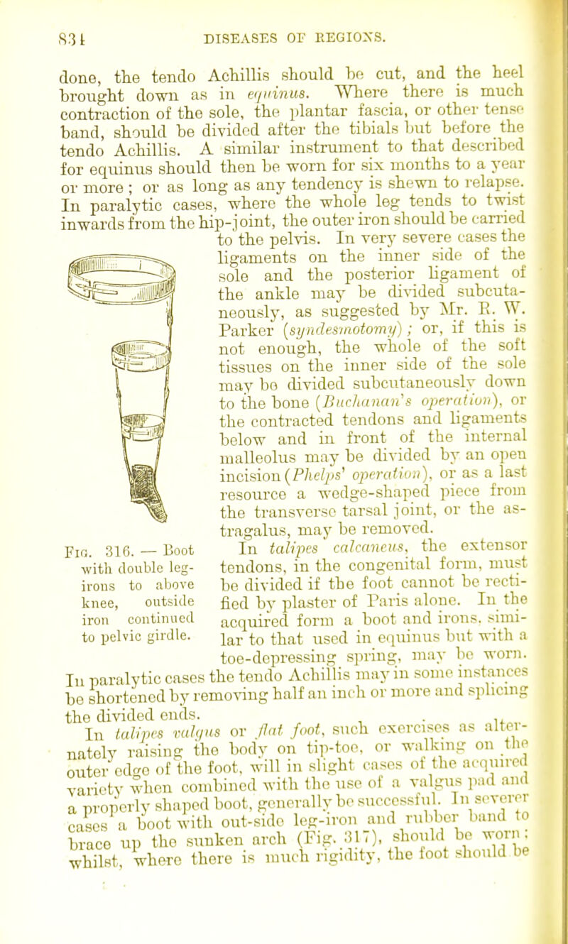 done, the tendo Achillis should be cut, and the heel brought down as in eijuinus. Where there is much contraction of the sole, the plantar fascia, or other tense band, should be divided after the tibials but before the tendo Achillis. A similar instrument to that described for equinus should then be worn for six months to a year or more ; or as long as any tendency is shewn to relapse. In paralytic cases, where the whole leg tends to twist inwards from the hip-joint, the outer iron should be carried to the pelvis. In very severe cases the ligaments on the inner side of the sole and the posterior ligament of the ankle may be di^-ided subcuta- neously, as suggested by Mr. E. W- Parker [syndesiaotomy); or, if this is not enough, the whole of the soft tissues on the inner side of the sole may be divided subcutaneously down to the bone [BncJianans ojjemtiun), or the contracted tendons and ligaments below and in front of the internal malleolus may be divided by an open incision {Phelps^ operation), resource a wedge-shaped the transverse tarsal joint tragalus, may be removed. In talipes caJccmcus. the extensor tendons, in the congenital form, must be divided if the foot cannot be recti- fied by plaster of Paris alone. In the acquired form a boot and irons, .-^nni- lar to that used in equinus but with a toe-depressino; spring, may bo worn. In paralytic cases the tendo Achillis may in some instances be shortened by removing half an inch or more and splicuig the divided ends. . In talipes vah/HS or Jlat foot, such exercises as alt^i- nately raisin- the body on tip-toe, or walking on the outer edcro of the foot, will in slight cases of the acquired variety when combined with the use of a valgus pad and a properly shaped boot, generally be successlnl I '''^voror cases a boot with out-side leg-iron and rubber band to brace up the sunken arch (Fig. 317), should be wor.K whilst, where there is much rigidity, the foot should be or as a last piece from or the as- Fio. 316. — Boot with double leg- irous to above knee, outside iron continued to pelvic girdle.