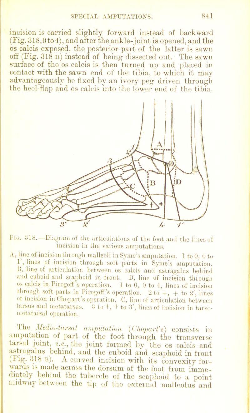 incision is carried slightly forward instead of backward (Fig. 31S,0to4), and after the ankle-joint is opened, and the OS calcis exposed, the posterior part of the latter is sawn off (Fig. 318 d) instead of being dissected out. The sawn siu'face of the os calcis is then turned up and placed in contact with the sawn end of the tibia, to which it may advantageously be hxed by an ivory peg driven through the heel-flap and os calcis into the lower end of the tibia. Fkj. -ilt;.—Diiignuii of tlie articiihiiiunf^ of tlic tout ami tliu lilies of incision in tlie varioii.s ainpiitations. .V, lino of incision tlirougli malleoli in Syme'.s amputation. 1 to 0, 0 to r, lines of incision throngli soft parts in Syme's amputation. I'j, line of articulation between os calcis and astragalus beliiml and cuboid ;uul scaiilioid iu front. D, line of incision tlirougli OS calcis in Pirogotfs operation. 1 to 0, 0 to 4, lines of incision througli soft parts in Pirogoff's oiieratioii. 2 to +, + to 2', lines of incision in Choparfs operation. C, line of articulation between tarsus and mctrttarsiis. :'. to -K t to lines of incision in ttvrsi - metatarsal operation. The MvdIu-turHitl (iinputntivn {CJioparfs) con.sists iu iiuiputation of pai-t of the foot through the transverse tarsal jonit, 'i.e., the joint formed by the os calcis and ustrag-idus behind, and the cuboid and scaphoid in front Fig. :nH b). a curved incision with its convexity for- wards is made across the dorsum of the foot from imme- diately behind the tubrrdo of the scajihoid to a point midway between the tip of the external mullcolus and