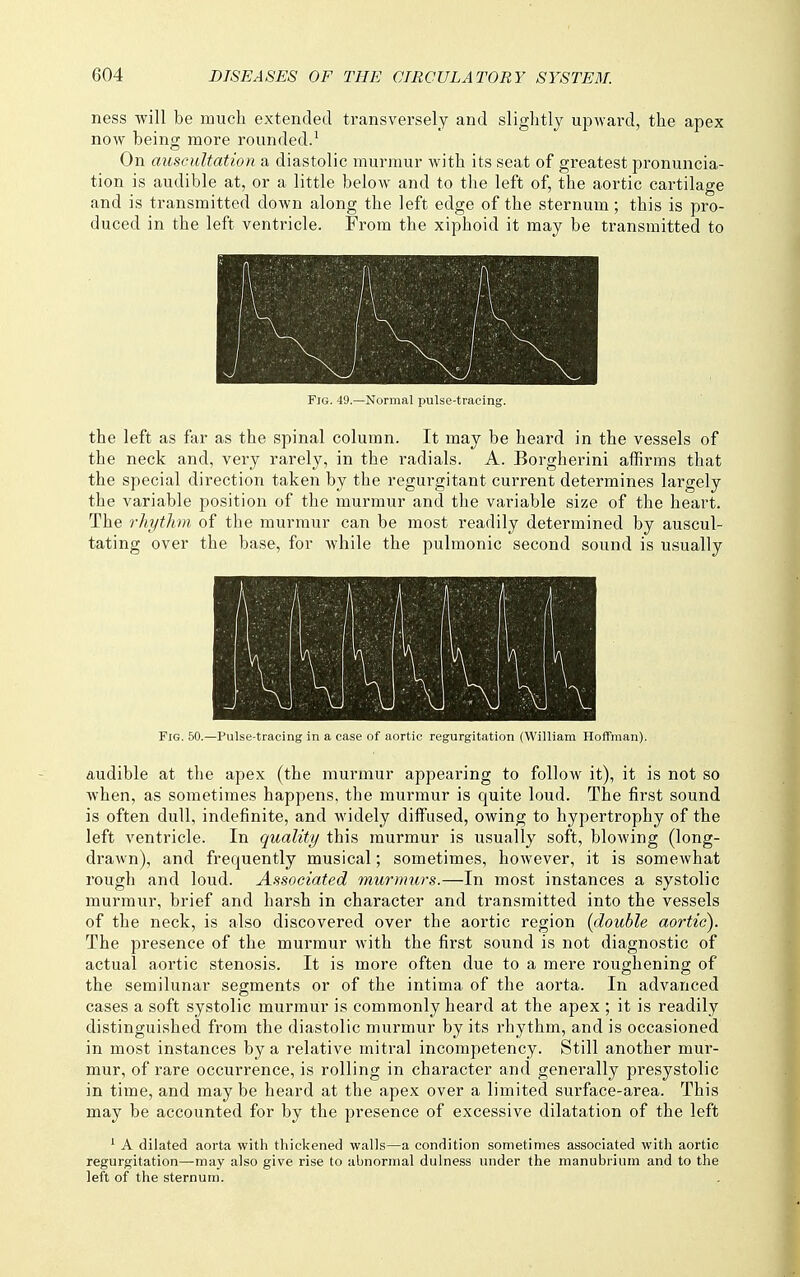 ness will be much extended transversely and slightly upward, the apex now being more rounded.' On auscultation a diastolic murmur with its seat of greatest pronuncia- tion is audible at, or a little below and to the left of, the aortic cartilage and is transmitted down along the left edge of the sternum; this is pro- duced in the left ventricle. From the xiphoid it may be transmitted to Fig. 49.—Normal pulse-tracing. the left as far as the spinal column. It may be heard in the vessels of the neck and, very rarely, in the radials. A. Borgherini affirms that the special direction taken by the regurgitant current determines largely the variable position of the murmur and the variable size of the heart. The rhythm of the murmur can be most readily determined by auscul- tating over the base, for while the pulmonic second sound is usually \ 1a. :;v \ s 1 V \ A. 1 . u 1 V Fig. 50.—Pulse-tracing in a case of aortic regurgitation (William Hoffman). audible at the apex (the murmur appearing to follow it), it is not so when, as sometimes happens, the murmur is quite loud. The first sound is often dull, indefinite, and widely diffused, owing to hypertrophy of the left ventricle. In quality this murmur is usually soft, blowing (long- drawn), and frequently musical; sometimes, however, it is somewhat rough and loud. Associated murmurs.—In most instances a systolic murmur, brief and harsh in character and transmitted into the vessels of the neck, is also discovered over the aortic region [double aortic). The presence of the murmur with the first sound is not diagnostic of actual aortic stenosis. It is more often due to a mere roughening of the semilunar segments or of the intima of the aorta. In advanced cases a soft systolic murmur is commonly heard at the apex ; it is readily distinguished from the diastolic murmur by its rhythm, and is occasioned in most instances by a relative mitral incompetency. Still another mur- mur, of rare occurrence, is rolling in character and generally presystolic in time, and may be heard at the apex over a limited surface-area. This may be accounted for by the presence of excessive dilatation of the left ' A dilated aorta with thickened walls—a condition sometimes associated with aortic regurgitation—may also give rise to abnormal dulness under the manubrium and to the left of the sternum.