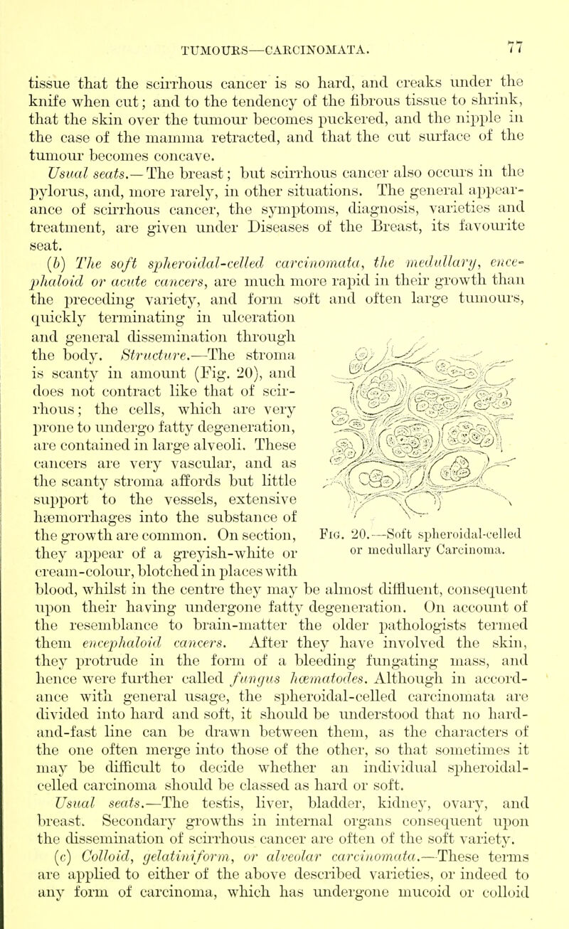 tissue that the scirrhous cancer is so hard, and creaks under the knife when cut; and to the tendency of the fibrous tissue to shrink, that the skin over the tumour becomes puckered, and the nipple in the case of the mamma retracted, and that the cut surface of the tumour becomes concave. Usual sm^s.—The breast; but scirrhous cancer also occurs in the pylorus, and, more rarely, in other situations. The general appear- ance of scirrhous cancer, the symptoms, diagnosis, varieties and treatment, are given under Diseases of the Breast, its favomite seat. (6) The soft spheroidal-celled carcinomata, the inedullary, ence- ■phaloid or acute cancers, are much more rapid in their growth than the preceding variety, and form soft and often large tumours, quickly terminating in ulceration and general dissemination through the body. Structure.—The stroma is scanty in amount (Fig. 20), and does not contract like that of scir- rhous ; the cells, which are very prone to undergo fatty degeneration, are contained in large alveoli. These cancers are very vascular, and as the scanty stroma affords but little support to the vessels, extensive hgemorrhages into the substance of the growth are common. On section, they appear of a greyish-white or cream-colour, blotched in places with blood, whilst in the centre they may be almost diffluent, consequent upon their having undergone fatty degeneration. On account of the resemblance to brain-matter the older pathologists termed them encephaloid cancers. After they have involved the skin, they protrude in the form of a bleeding fungating mass, and hence were further called fungus hcematodes. Although in accord- ance with general usage, the spheroidal-celled carcinomata are divided into hard and soft, it should be understood that no hard- and-fast line can be drawn between them, as the characters of the one often merge into those of the other, so that sometimes it may be difficult to decide whether an individual s2:>heroidal- celled carcinoma should be classed as hard or soft. Usual seats.—The testis, liver, bladder, kidney, ovary, and lu-east. Secondary growths in internal organs consequent upon the dissemination of sciiThous cancer are often of the soft variety. (c) Colloid, gelatimform, or alveolar carcinomata,—These terms are applied to either of the above described varieties, or indeed to any form of carcinoma, which has imdergoiie mucoid or colloid Fig. 20.—Soft spheroidal-celled or medullary Carcinoma.