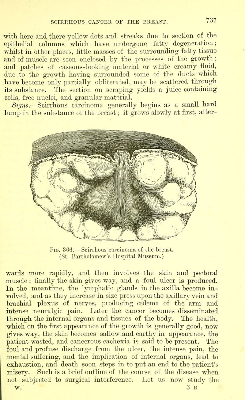 with here and there yellow dots and streaks due to section of the epithelial columns which have undergone fatty degeneration; whilst in other places, little masses of the surrounding fatty tissue and of muscle are seen enclosed by the processes of the growth; and patches of caseous-looking material or white creamy fluid, due to the growth having surrounded some of the ducts which have become only partially obliterated, may be scattered through its substance. The section on scraping yields a juice containing cells, free nuclei, and granular material. Signs.—Scirrhous carcinoma generally begins as a small hard lump in the substance of the breast; it grows slowly at first, after- FiG. 366.—Scirrhous carcinoma of the breast. (St. Bartholomew's Hospital Museum.) wards more rapidly, and then involves the skin and pectoral muscle ; finally the skin gives way, and a foul ulcer is produced. In the meantime, the Ijrmphatic glands in the axilla become in- volved, and as they increase in size press upon the axillary vein and brachial plexus of nerves, producing oedema of the arm and intense neuralgic pain. Later the cancer becomes disseminated through the internal organs and tissues of the body. The health, which on the first appearance of the growth is generally good, now gives way, the skin becomes sallow and earthy in appearance, the patient wasted, and cancerous cachexia is said to be present. The foul and profuse discharge from the ulcer, the intense pain, the mental suffering, and the implication of internal organs, lead to exhaustion, and death soon steps in to put an end to the patient's misery. Such is a brief outline of the course of the disease when not subjected to sui'gical interference. Let us now study the w. 3 b