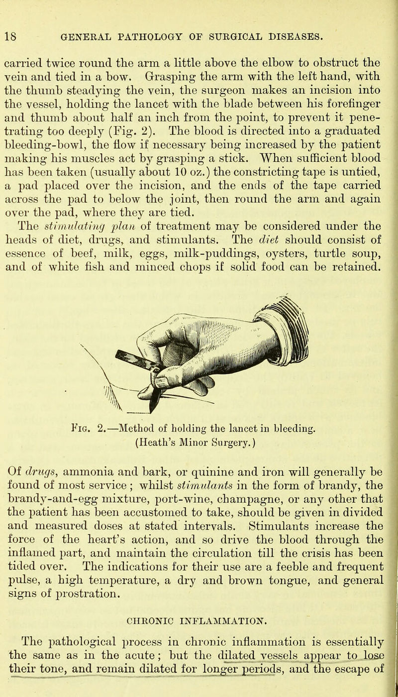 carried twice round the arm a little above the elbow to obstruct the vein and tied in a bow. Grasping the arm with the left hand, with the thumb steadying the vein, the surgeon makes an incision into the vessel, holding the lancet with the blade between his forefinger and thumb about half an inch from the point, to prevent it pene- trating too deeply (Fig. 2). The blood is directed into a graduated bleeding-bowl, the flow if necessary being increased by the patient making his muscles act by grasping a stick. When sufficient blood has been taken (usually about 10 oz.) the constricting tape is untied, a pad placed over the incision, and the ends of the tape carried across the pad to below the joint, then round the arm and again over the pad, where they are tied. The stiinuhitiiig plan of treatment may be considered under the heads of diet, drugs, and stimulants. The diet should consist of essence of beef, milk, eggs, milk-puddings, oysters, turtle soup, and of white fish and minced chops if solid food can be retained. Fig. 2.—Method of holding the lancet in bleeding. (Heath's Minor Surgery.) Of drugs, ammonia and bark, or quinine and iron will generally be found of most service ; whilst stimulants in the form of brandy, the brandy-and-egg mixtiu-e, port-wine, champagne, or any other that the patient has been accustomed to take, should be given in divided and measured doses at stated intervals. Stimulants increase the force of the heart's action, and so drive the blood through the inflamed j^art, and maintain the circulation till the crisis has been tided over. The indications for their use are a feeble and frequent pulse, a high temperature, a dry and brown tongue, and general signs of prostration. CHRONIC INFLAMMATION. The j)athological process in chronic inflammation is essentially the same as in the acute; but the dilated vessels appear to lose their tone, and remain dilated for longer periods, and the escape of