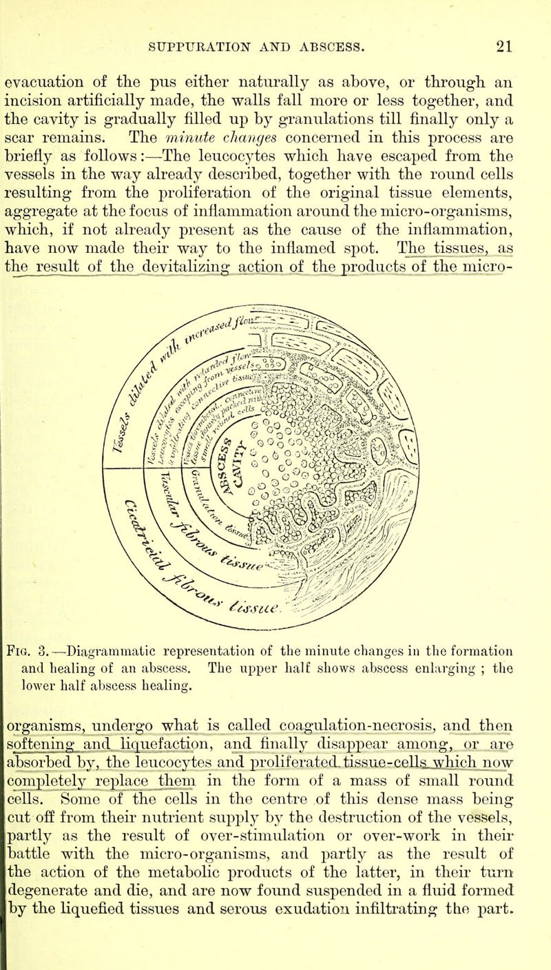evacuation of the pus either naturally as above, or through an incision artificially made, the walls fall more or less together, and the cavity is gradually filled up by granulations till finally only a scar remains. The minute changes concerned in this process are briefly as follows:—The leucocytes which have escaped from the vessels in the way already described, together with the round cells resulting from the proliferation of the original tissue elements, aggregate at the focus of inflammation around the micro-organisms, which, if not already present as the cause of the inflammation, have now made their way to the inflamed spot. The Jissues, as the result of the devitalizing action of the products of the micro- FiG. 3.—Diagrammatic representation of the minute changes in the formation and healing of an abscess. The u^oper half shows abscess enlarging ; the lower half abscess healing. organisms, undergo what is called coagulation-necrosis, and then softening_ and, liquefaction, and finally disappear among, or are absorbed by, the leucocytes and proliferated, tissue-ceUsjEhich now completely replace them in the form of a mass of small round cells. Some of the cells in the centre of this dense mass being cut off from their nutrient supply by the destruction of the vessels, partly as the result of over-stimulation or over-work in their battle with the micro-organisms, and partly as the result of the action of the metabolic products of the latter, in their turn degenerate and die, and are now found suspended in a fluid formed by the liquefied tissues and serous exudation infilti'ating the part.