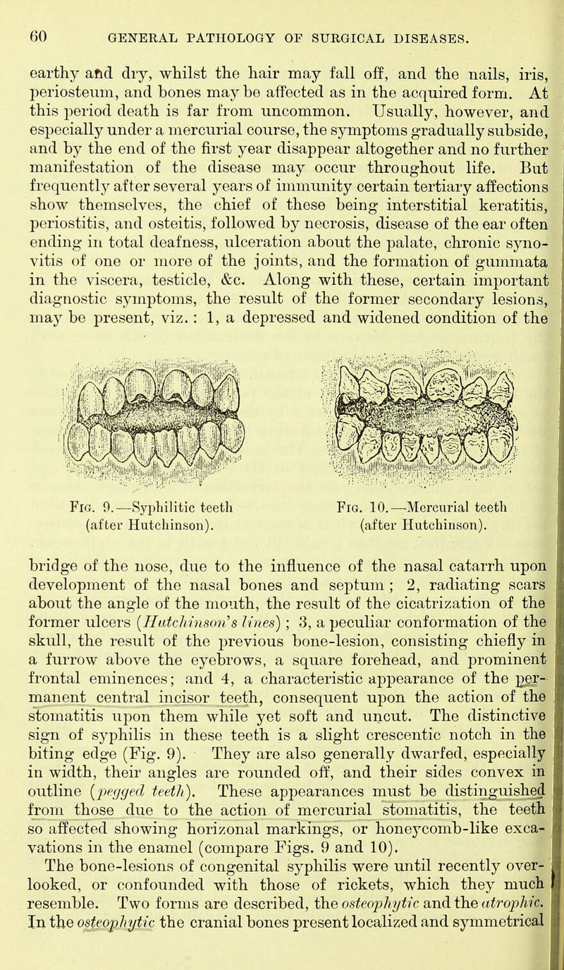 earthy aftd dry, whilst the hair may fall off, and the nails, iris, periosteum, and bones may be affected as in the acquired form. At this period death is far from uncommon. Usually, however, and especially under a mercurial course, the symptoms gradually subside, and by the end of the first year disappear altogether and no further manifestation of the disease may occur throughout life. But frequently after several years of immunity certain tertiary affections show themselves, the chief of these being interstitial keratitis, periostitis, and osteitis, followed by necrosis, disease of the ear often ending in total deafness, ulceration about the palate, chronic syno- vitis of one or more of the joints, and the formation of gummata in the viscera, testicle, &c. Along with these, certain important diagnostic symptoms, the result of the former secondary lesions, may be present, viz.: 1, a depressed and widened condition of the Fig, 9.—Syphilitic teeth Fig. 10.—Mercurial teeth (after Hutchinson), (after Hutchinson). bridge of the nose, due to the influence of the nasal catarrh upon development of the nasal bones and septum ; 2, radiating scars about the angle of the mouth, the result of the cicatrization of the former ulcers {Hutchinson's lines) ; 3, a peculiar conformation of the skull, the result of the i^revious bone-lesion, consisting chiefly in a furrow above the eyebrows, a square forehead, and prominent frontal eminences; and 4, a characteristic appearance of the per- manent central incisor teeth, consequent upon the action of the stomatitis upon them while yet soft and uncut. The distinctive sign of syphilis in these teeth is a slight crescentic notch in the biting edge (Fig. 9). They are also generally dwarfed, especially in width, their angles are rounded off, and their sides convex in outline {pegged teeth). These appearances must be distinguished from those due to the action of mercurial stomatitis, the teeth so affected showing horizonal markings, or honeycomb-like exca- vations in the enamel (compare Figs. 9 and 10). The bone-lesions of congenital syphilis were until recently over- looked, or confounded with those of rickets, which they much resemble. Two forms are described, the osteophytic and the atrophic. In the osteophytic the cranial bones present localized and symmetrical