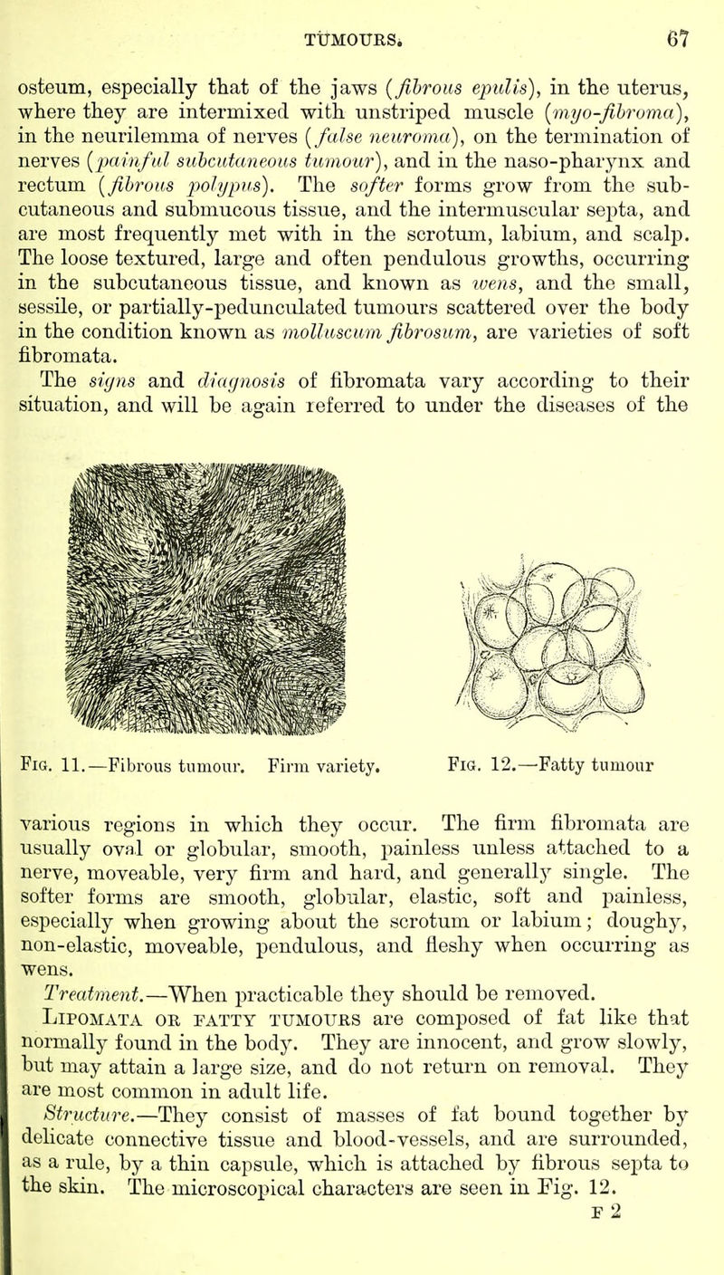 osteum, especially tliat of the jaws {fihrous epulis), in the uterns, where they are intermixed with unstriped muscle [myo-fihroma), in the neurilemma of nerves [false neuroma), on the termination of nerves {painfal subcutaneous tumour), and in the naso-pharynx and rectum [fihrous polypus). The softer forms grow from the sub- cutaneous and submucous tissue, and the intermuscular septa, and are most frequently met with in the scrotum, labium, and scalp. The loose textured, large and often pendulous growths, occurring in the subcutaneous tissue, and known as luens, and the small, sessile, or partially-pedunculated tumours scattered over the body in the condition known as molluscuni fibrosum, are varieties of soft fibromata. The signs and diagnosis of fibromata vary according to their situation, and will be again referred to under the diseases of the Fig. 11.—Fibrous tumour. Firm variety. Fia. 12.—Fatty tumour various regions in which they occur. The firm fibromata are usually oval or globular, smooth, painless unless attached to a nerve, moveable, very firm and hard, and generally single. The softer forms are smooth, globular, elastic, soft and painless, especially when growing about the scrotum or labium; doughy, non-elastic, moveable, pendulous, and fleshy when occurring as wens. Treatment.—When practicable they should be removed. LiPOMATA OR FATTY TUMOURS are composed of fat like that normally found in the body. They are innocent, and grow slowly, but may attain a large size, and do not return on removal. They are most common in adult life. Structure.—They consist of masses of fat bound together by delicate connective tissue and blood-vessels, and are surrounded, as a rule, by a thin capsule, which is attached by fibrous septa to the skin. The microscopical characters are seen in Fig. 12. F 2