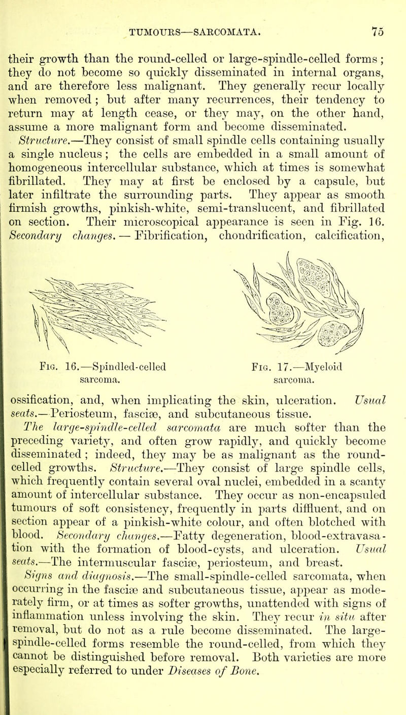 their growth than the round-celled or large-spindle-celled forms; they do not become so quickly disseminated in internal organs, and are therefore less malignant. They generally recur locally when removed ; but after many recurrences, their tendency to return may at length cease, or they may, on the other hand, assume a more malignant form and become disseminated. Structure.—They consist of small spindle cells containing usually a single nucleus ; the cells are embedded in a small amount of homogeneous intercellular substance, which at times is somewhat fibrillated. They may at first be enclosed by a capsule, but later infiltrate the surrounding parts. They appear as smooth firmish growths, j^inkish-white, semi-translucent, and fibrillated on section. Their microscopical aj)pearance is seen in Fig. 16. Secondary changes. — Fibrification, chondrification, calcification. ossification, and, when implicating the skin, ulceration. Usual seats.—Periosteum, fasciae, and subcutaneous tissue. The large-spindle-celled sarcomata are much softer than the preceding variety, and often grow rapidly, and quickly become disseminated ; indeed, they may be as malignant as the round- celled growths. Structure.—They consist of large spindle cells, which frequently contain several oval nuclei, embedded in a scanty amount of intercellular substance. They occur as non-encapsuled tumours of soft consistency, frequently in parts diffluent, and on section appear of a pinkish-white colour, and often blotched with blood. Secondary changes.—Fatty degeneration, blood-extravasa- tion with the formation of blood-cysts, and ulceration. Usual seats.—The intermuscular fascise, j)eriosteum, and breast. Signs and diagnosis.—The small-spindle-celled sarcomata, when occurring in the fasciae and subcutaneous tissue, appear as mode- rately firm, or at times as softer growths, unattended with signs of inflannnation unless involving the skin. They recur in situ after removal, but do not as a rule become disseminated. The large- spindle-celled forms resemble the round-celled, from which they cannot be distinguished before removal. Both varieties are more especially referred to under Diseases of Bone. Fig. 16.—Spindled-celled Fig. 17.—Myeloid sarcoma. sarcoma.