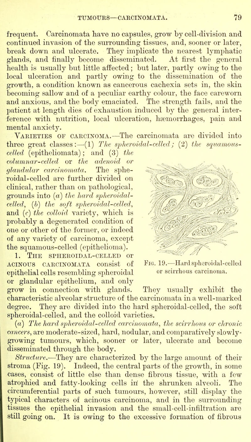 frequent. Carcinomata have no capsules, grow by cell-division and continued invasion of the surrounding tissues, and, sooner or later, break down and ulcerate. They implicate the nearest lymphatic glands, and finally become disseminated. At first the general health is usually but little affected; but later, i^artly owing to the local ulceration and partly owing to the dissemination of the growth, a condition known as cancerous cachexia sets in, the skin becoming sallow and of a peculiar earthy colour, the face careworn and anxious, and the body emaciated. The strength fails, and the patient at length dies of exhaustion induced by the general inter- ference with nutrition, local ulceration, hsemorrhages, pain and mental anxiety. Varieties of carcinoma.—The carcinomata are divided into three great classes:—(1) The spheroidal-cclhd; (2) the sqnamous- celled (epitheliomata); and (3) the columnar-celled or the adenoid or glandular carcinomata. The sphe- ^ ~ - ^ ^ Toidal-celled are further divided on  ■ ^' '/ clinical, rather than on pathological, : - (\Sv^ grounds into (a) the hard spheroidal- ' . ^\'V;' celled, [h) the soft spheroidal-celled, ' ; ' !l and (c) the colloid variety, which is - ' -^J^ probably a degenerated condition of one or other of the former, or indeed ' ('- of any variety of carcinoma, except the squamous-celled (ej)ithelioma). > . 1. The spheroidal-celled or - ACINOUS carcinomata consist of Fio- 19.—Hard spheroidal-celled epithelial cells resembling spheroidal or scirrhous carcinoma, or glandular epithelium, and only grow in connection with glands. They usually exhibit the characteristic alveolar structure of the carcinomata in a well-marked degree. They are divided into the hard spheroidal-celled, the soft spheroidal-celled, and the colloid varieties. (a) The hard sp)heroidal-celled carcinomata, the scirrhous or chronic cancers, are moderate-sized, hard, nodular, and comparatively slowly- growing tumours, which, sooner or later, ulcerate and become disseminated through the body. Structure.—They are characterized by the large amount of their stroma (Fig. 19). Indeed, the central parts of the growth, in some cases, consist of little else than dense fibrous tissue, with a few atrophied and fatty-looking cells itL the shrunken alveoli. The circumferential parts of such tumours, however, still display the typical characters of acinous carcinoma, and in the surrounding tissues the epithelial invasion and the small-cell-infiltration are still going on. It is owing to the excessive formation of fibrous