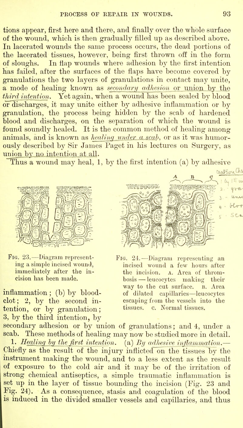 tions appear, first here and there, and finally over the whole surface of the wound, which is then gradually filled up as described above. In lacerated wounds the same process occurs, the dead portions of the lacerated tissues, however, being first thrown off in the form of sloughs. In flap wounds where adhesion by the first intention has failed, after the surfaces of the flaps have become covered by granulations the two layers of granulations in contact may unite, a mode of healing known as secondarij adht'slon or union by the third intentuni. Yet again, when a wound has been sealed by blood or discharges, it may unite either by adhesive inflammation or by granulation, the process being hidden by the scab of hardened blood and discharges, on the separation of which the wound is found soundly healed. It is the common method of healing among animals, and is known as heaHnci under a scaj), or as it was humor- ously described by Sir James Paget in his lectures on Surgery, as union by no intention at all. ■^us a wound may heal, 1, by the first intention (a) by adhesive Fig. 23.—Diagram represent- ing a simple incised wound, immediately after the in- cision has been made. Fig. 24.—Diagram representing an incised wound a few hours after the incision, a. Area of throm- bosis— leucocyte.s making their way to the cut surface, b. Area of dilated capillaries—leucocytes escaping from the vessels into the tissues, c. Normal tissues. mflammation ; (b) by blood- clot; 2, by the second in- tention, or by granulation; 3, by the third intention, by secondary adhesion or by union of granulations; and 4, under a scab. These methods of healing may now be studied more in detail. 1. H§aJmg bj/ the first intention , (a) By adhesive irijlammation.— Chiefly as the result of the injury inflicted~on the tissues by the instrument making the wound, and to a less extent as the result of exposure to the cold air and it may be of the irritation of strong chemical antiseptics, a simple traumatic inflammation is set up in the layer of tissue bounding the incision (Fig. 23 and Fig. 24). As a consequence, stasis and coagulation of the blood is induced in the divided smaller vessels and capillaries, and thus