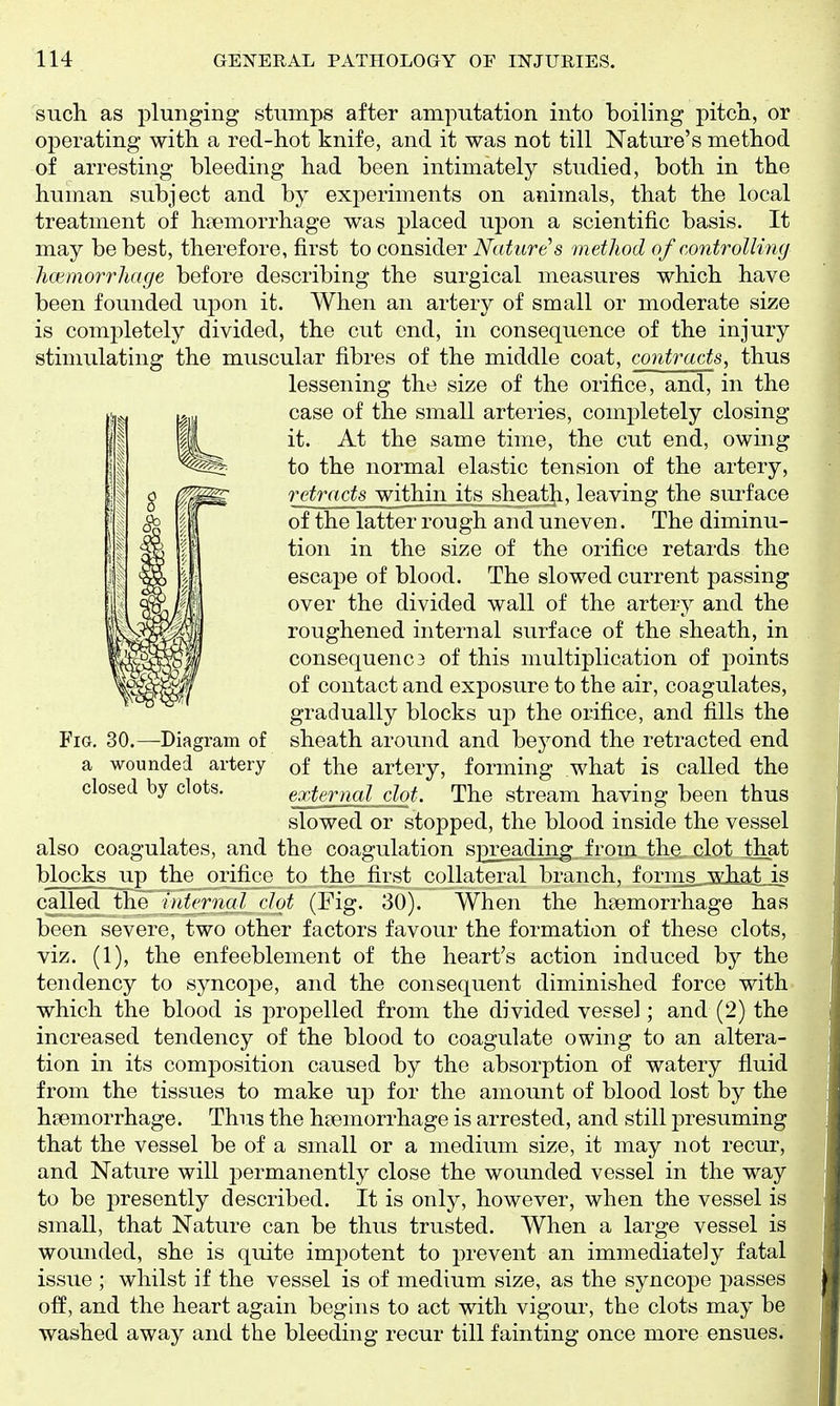 such as plunging stumps after amputation into boiling pitch, ov operating with a red-hot knife, and it was not till Nature's method of arresting bleeding had been intimately studied, both in the human subject and by experiments on animals, that the local treatment of haemorrhage was placed upon a scientific basis. It may behest, therefore, first to consider Nature's method of controlling hcemorrhage before describing the surgical measures which have been founded upon it. When an artery of small or moderate size is completely divided, the cut end, in consequence of the injury stimulating the muscular fibres of the middle coat, contracts, thus lessening the size of the orifice, and, in the .-^ (^,, case of the small arteries, comj^letely closing (I vM^ same time, the cut end, owing j| to the normal elastic tension of the artery, retracts within its sheath, leaving the surface of the latter rough and uneven. The diminu- tion in the size of the orifice retards the escape of blood. The slowed current passing over the divided wall of the artery and the roughened internal surface of the sheath, in consequence of this multiplication of points of contact and exposure to the air, coagulates, gradually blocks up the orifice, and fills the Fig, 30.—Diagram of sheath around and beyond the retracted end a wounded artery of the artery, forming what is called the closed by clots. external clot. The stream having been thus slowed or stopped, the blood inside the vessel also coagulates, and the coagulation spreading from the clot that blocks up the orifice to the first collateral branch, forins_„what_is called the internal clot (Fig. 80). When the haemorrhage has been severe, two other factors favour the formation of these clots, viz. (1), the enfeeblement of the heart's action induced by the tendency to syncope, and the consequent diminished force with which the blood is propelled from the divided vessel; and (2) the increased tendency of the blood to coagulate owing to an altera- tion in its composition caused by the absorption of watery fluid from the tissues to make up for the amount of blood lost by the haemorrhage. Thus the haemorrhage is arrested, and still presuming that the vessel be of a small or a medium size, it may not recur, and Nature will permanently close the wounded vessel in the way to be presently described. It is only, however, when the vessel is small, that Nature can be thus trusted. When a large vessel is wounded, she is quite impotent to prevent an immediately fatal issue ; whilst if the vessel is of medium size, as the syncope passes off, and the heart again begins to act with vigour, the clots may be washed away and the bleeding recur till fainting once more ensues.
