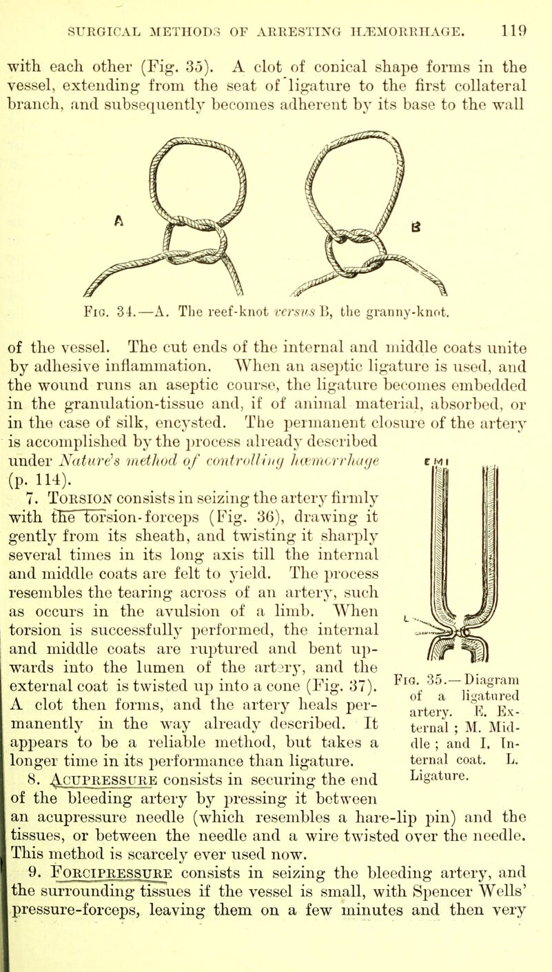 with each other (Fig. 35). A clot of conical shape forms in the vessel, extending from the seat of ligature to the first collateral branch, and subsequently becomes adherent by its base to the wall Fig. 34.—A, The reef-knot rc?-.s;/.s B, the granny-knot, of the vessel. The cut ends of the internal and middle coats unite by adhesive inflammation. When an aseptic ligature is used, and the wound runs an aseptic course, the ligature becomes embedded in the granulation-tissue and, if of animal material, absorbed, or in the case of silk, encysted. The permanent closure of the artery is accomplished by the i)rocess ali'eady described under Nature's method of controJJiiuj hctmorrJuK/e (p. 114). 7. Torsion consists in seizing the arter} firmly with the torsion-forceps (Fig. 36), drawing it gently from its sheath, and twisting it sharply several times in its long axis till the internal and middle coats are felt to yield. The process resembles the tearing across of an artery, such as occurs in the avulsion of a limb. When torsion is successfully performed, the internal and middle coats are ruptured and bent up- wards into the lumen of the artarj^ and the external coat is twisted up into a cone (Fig. 37). A clot then forms, and the artery heals per- manently in the way already described. It appears to be a reliable method, but takes a longer time in its jierformance than ligature. AoTJFRESSURE consists in securing the end Fig. 35.—Diagram of a ligatured artery. E. Ex- ternal ; M. Mid- dle ; and I. In- ternal coat. L. Ligature. of the bleeding artery by pressing it between an acupressure needle (which resembles a hare-lip pin) and the tissues, or between the needle and a wire twisted over the needle. This method is scarcely ever used now. 9. FoRCiPRESSiJRE consists in seizing the bleeding artery, and the surrounding tissues if the vessel is small, with Spencer Wells' pressure-forceps, leaving them on a few minutes and then very