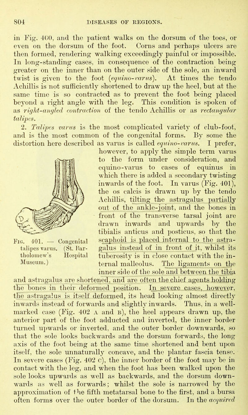 in Ei^'. 4(10, and the j)atient walks on the dorsum of the toes, or even on the dorsum of the foot. Corns and perhaps ulcers are then formed, rendering walking exceedingly painful or impossible. In long-standing cases, in consequence of the contraction being greater on the inner than on the outer side of the sole, an inward twist is given to the foot {equina-rarus). At times the tendo Achillis is not sufficiently shortened to draw up the heel, but at the same time is so contracted as to prevent the foot being placed beyond a right angle with the leg. This condition is spoken of as right-anghd contradion of the tendo Achillis or as rectangular talijjes. 2. Talipes varus is the most complicated variety of club-foot, and is the most common of the congenital forms. By some the distortion here described as varus is called equrno-varus. I prefer, however, to apply the simple term varus to the form under consideration, and equino-varus to cases of equinus in which there is added a secondary twisting inwards of the foot. In varus (Fig. 401), the OS calcis is drawn up by the tendo Achillis, tilting the astragalus j^arti'^lly out of the ankle-joint, and the bones in front of the transverse tarsal joint are drawn inwards and upwards by the tibialis anticus and jiosticus, so that the scaphoid is placed internal to the astra- galus instead of in front of it, whilst its tuberosity is in close contact with the in- ternal malleolus. The ligaments on the inner side of the sole and between the tibia and astragalus are shortened, and are often the chief agents holding the bones in their deformed position. In,..severe cases, however, the astragalus is itself deformed, its head looking almost directly inwards instead of forwards and slightly inwards. Thus, in a well- marked case (Fig. 402 a and b), the heel appears drawn up, the anterior part of the foot adducted and inverted, the inner border turned upwards or inverted, and the outer border downwards, so that the sole looks backwards and the dorsum forwards, the long axis of the foot being at the same time shortened and bent upon itself, the sole unnaturally concave, and the j^lantar fascia tense. In severe cases (Fig. 402 c), the inner border of the foot may be in contact with the leg, and when the foot has been walked upon the sole looks upwards as well as backwards, and the dorsum down- wards as well as forwards; whilst the sole is narrowed by the approximation of the fifth metatarsal bone to the first, and a bursa often forms over the outer border of the dorsum. In the acquired Fig, 401. — talipes varus, tholomew's Museum.) Congenital (St. l!ar- Hosi)ital