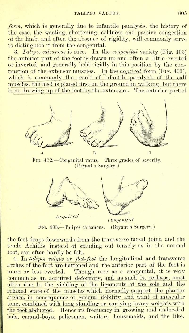 form, which is generally due to infantile paralysis, the history of the case, the wasting, shortening, coldness and passive congestion of the limb, and often the absence of rigidity, will commonly serve to distinguish it from the congenital. 3. Talipes calcaneus is rare. In the couyenital variety (Fig. 403) the anterior part of the foot is drawn wp and often a little everted or inverted, and generally held rigidly in this position by the con- traction of the extensor muscles. In the^cicqiiired form (Fig. 403), wliich is commonly the result of infantile paralysis of the calf muscles, the heel is placed fet on the ground in walking, but there is no drawing up of the foot by the extensors. The anterior part of A B c Fig. 402.—Congenital varus. Three grades of severity. (Bryant's Surgery.) Fig. 403.—Talipes calcaneus. (]>ryant's Surgery.) the foot drops downwards from the transverse tarsal joint, and the tendo Achillis, instead of standing out tensely as in the normal foot, can often hardly be felt. 4. In talipes valgus or flat-foot the longitudinal and transverse arches of the foot are flattened and the anterior part of the foot is more or less everted. Though rare as a congenital, it is very common as an acquired deformity, and as such is, perhaps, most_ often due to the yielding of the ligaments of the sole and the relaxed state of the muscles which normally support the plantar arches, in consequence of general debility and want of muscular tone, combined with long standing or carrying heavy weights with the feet abducted. Hence its frequency in growing and under-fed lads, errand-boys, policemen, waiters, housemaids, and the like.