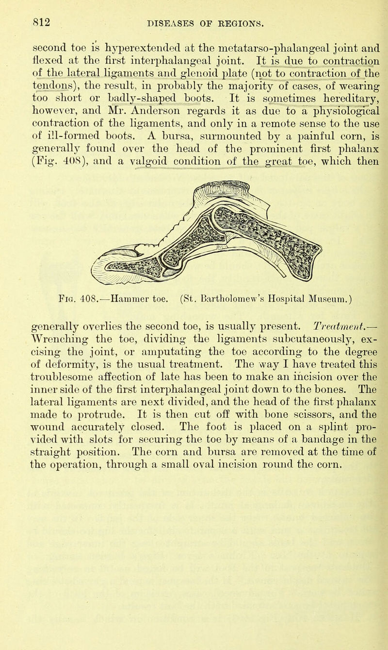 second toe is hyperextended at the metatarso-phalangeal joint and flexed at the first interphalangeal joint. It is due to contraction of the lateral ligaments and glenoid plate (not to contraction of the tendons), the result, in probably the majority of cases, of wearing too short or badly-shaped boots. It is sometimes hereditary, however, and Mr. Anderson regards it as due to a physiological contraction of the ligaments, and only in a remote sense to the use of ill-formed boots. A bursa, surmounted by a painful corn, is generally found over the head of the prominent first phalanx (Fig. 4()(S), and a valgoid condition of the great toe, which then Fig. 408.—Hammer toe. (St. Bartholomew's Hospital Museum.) generally overlies the second toe, is usually present. Treatment,— Wrenching the toe, dividing the ligaments subcutaneously, ex- cising the joint, or amputating the toe according to the degree of deformity, is the usual treatment. The way I have treated this troublesome affection of late has been to make an incision over the inner side of the first interphalangeal joint down to the bones. The lateral ligaments are next divided, and the head of the first phalanx made to protrude. It is then cut off with bone scissors, and the wound accurately closed. The foot is placed on a splint pro- vided with slots for securing the toe by means of a bandage in the straight position. The corn and bursa are removed at the time of the operation, through a small oval incision round the corn.