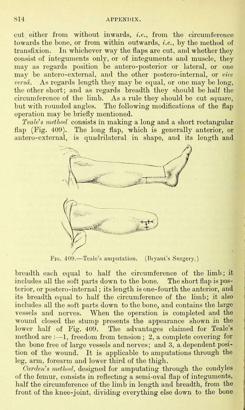 cut either from without inwards, i.e., from the circumference towards the bone, or from within outwards, i.e., by the method of transfixion. In whichever way the flaps are cut, and whether they consist of integuments only, or of integuments and muscle, they may as regards position be antero-posterior or lateral, or one may be antero-external, and the other postero-internal, or vice versa. As regards length they may be equal, or one may be long, the other short; and as regards breadth they should be half the circumference of the limb. As a rule they should be cut square, but with rounded angles. The following modifications of the flap operation may be briefly mentioned. Teak's method consists in making a long and a short rectangular flap (Fig. 409). The long flap, which is generally anterior, or antero-external, is quadrilateral in shape, and its length and breadth each equal to half the circumference of the limb; it includes all the soft parts down to the bone. The short flap is pos- terior, or postero-internal; its length is one-fourth the anterior, and its breadth equal to half the circumference of the limb; it also includes all the soft parts down to the bone, and contains the large vessels and nerves. When the operation is completed and the wound closed the stump presents the appearance shown in the lower half of Fig. 409. The advantages claimed for Teale's method are :—1, freedom from tension ; 2, a complete covering for the bone free of large vessels and nerves; and 3, a_dependent posi- tion of the wound. It is applicable to amputations through the leg, arm, forearm and lower third of the thigh. Cardenas method, designed for amputating through the condyles of the femur, consists in reflectmg a semi-oval flap of integuments, half the circumference of the limb in length and breadth, from the front of the knee-joint, dividing everything else down to the bone Fig. 409.—Teale's amputation. (Bryant's Surgery.)