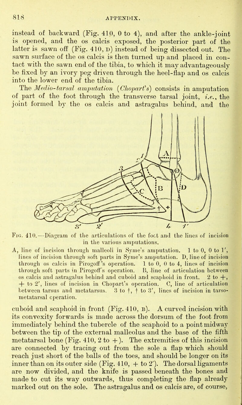 instead of backward (Fig. 410, 0 to 4), and after the ankle-joint is opened, and the os calcis exposed, the posteiior part of the latter is sawn off (Fig. 410, d) instead of being dissected out. The sawn surface of the os calcis is then turned up and placed in con- tact with the sawn end of the tibia, to which it may advantageously be fixed by an ivory peg driven through the heel-flap and os calcis into the lower end of the tibia. The Medio-tarsal amputation [GhoparVs) consists in amputation of part of the foot through the transverse tarsal joint, v'.e., the joint formed by the os calcis and astragalus behind, and the S' 2' I. 1' Fig. 410,—Diagi-am of the articulations of tlie foot and tlie lines of incision] in tlie various amputations. A, line of incision through malleoli in Syme's amputation. 1 to 0, 0 to 1', lines of incision through soft parts in Syme's amputation. D, line of incision! through OS calcis in Pirogoff's operation. 1 to 0, 0 to 4, lines of incisioni through soft parts in Pii'ogofFs operation. B, line of articulation between] OS calcis and astragalus behind and cuboid and scaphoid in front. 2 to -f-, -|- to 2', lines of incision in Chopart's operation. C, line of articulation between tarsus and metatarsus. 3 to f, f to 3', lines of incision in tarso-] metatarsal operation. cuboid and scaphoid in front (Fig. 410, b). A curved incision with its convexity forwards is made across the dorsum of the foot from immediately behind the tubercle of the scaphoid to a point midway between the tip of the external malleolus and the base of the fifth metatarsal bone (Fig. 410, 2 to +). The extremities of this incision are connected by tracing out from the sole a flap which should reach just short of the balls of the toes, and should be longer on its inner than on its outer side (Fig. 410, + to 2'). The dorsal ligaments are now divided, and the knife is passed beneath the bones and made to cut its way outwards, thus completing the flap already marked out on the sole. The astragalus and os calcis are, of course,