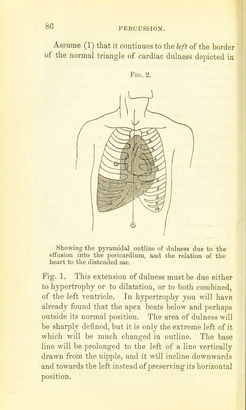 PERCUSSION. Assume (1) that it continues to the left of the border of the normal triangle of cardiac dulness depicted in Fig. 2. Showing the pyramidal outline of dulness due to the effusion into the pericardium, and the relation of the heart to the distended sac. Fig-. 1. This extension of dulness must be due either to hypertrophy or to dilatation, or to both combined, of the left ventricle. In hypertrophy you will have already found that the apex beats below and perhaps outside its normal position. The area of dulness will be sharply defined, but it is only the extreme left of it which will be much changed in outline. The base line will be prolonged to the left of a line vertically drawn from the nipple, and it will incline downwards and towards the left instead of preserving its horizontal position.