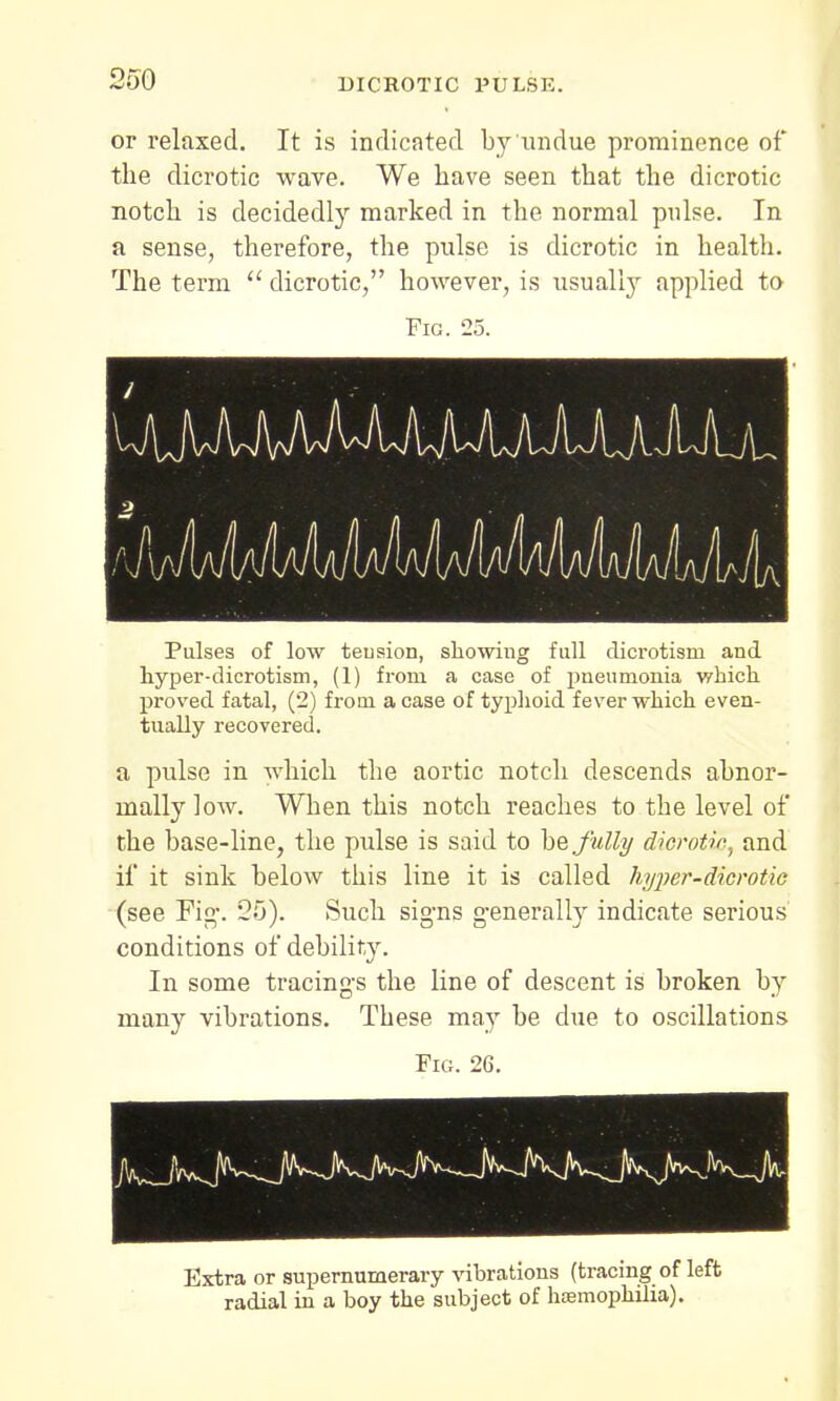 DICROTIC PULSE. or relaxed. It is indicated by undue prominence of the dicrotic wave. We have seen that the dicrotic notch is decidedly marked in the normal pulse. In a sense, therefore, the pulse is dicrotic in health. The term  dicrotic, however, is usually applied to Fig. 25. Pulses of low tension, showing full dicrotism and hyper-dierotism, (1) from a case of pneumonia which proved fatal, (2) from a case of typhoid fever which even- tually recovered. a pulse in which the aortic notch descends abnor- mally low. When this notch reaches to the level of the base-line, the pulse is said to be f ully dicrotic, and if it sink below this line it is called hyper-dicrotie (see Fig-. 25). Such signs generally indicate serious conditions of debility. In some tracing's the line of descent is broken by many vibrations. These may be clue to oscillations Fig. 26. Extra or supernumerary vibrations (tracing of left radial in a boy the subject of htemophilia).