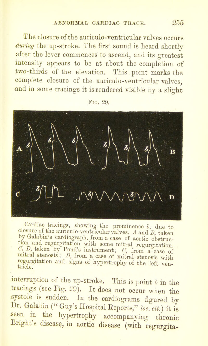 The closure of the auriculo-ventricular valves occurs during the up-stroke. The first sound is heard shortly after the lever commences to ascend, and its greatest intensity appears to he at ahout the completion of two-thirds of the elevation. This point marks the complete closure of the auriculo-ventricular valves, and in some tracings it is rendered visihle by a slight Fig. 29. Cardiac tracings, showing the prominence h, due to closure of the auriculo-ventricular valves. A and B, taken by Galabin's cardiograph, from a case of aortic obstruc- tion and regurgitation with some mitral regurgitation 6, D, taken by Pond's instrument, C, from a case of mitral stenosis ; D, from a case of mitral stenosis with regurgitation and signs of hypertrophy of the left ven- tncle. interruption of the up-stroke. This is point I in the tracings (see Fig. £9). It does not occur when the systole is sudden. In the cardiograms figured by Dr. Galabin ( Guv's Hospital Reports, loc. cit.) it is seen in the hypertrophy accompanying chronic Bnght's disease, in aortic disease (with regurgita-