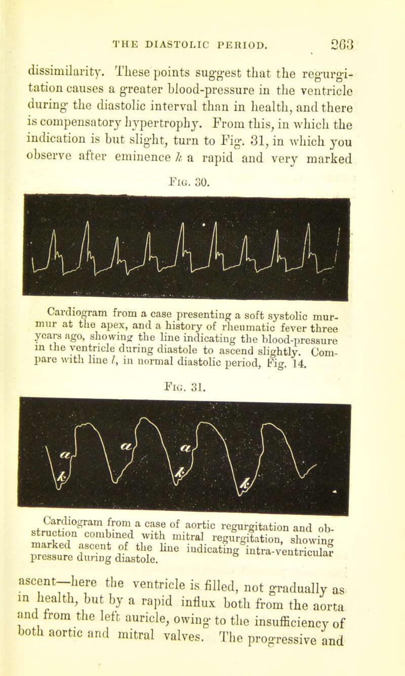 dissimilarity. These points suggest that the regurgi- tation causes a greater blood-pressure in the ventricle during the diastolic interval than in health, and there is compensatory hypertrophy. From this, in which the indication is but slight, turn to Fig. 31, in which you observe after eminence It a rapid and very marked Fig. 30. Cardiogram from a case presenting a soft systolic mur- mur at the apex, and a history of rheumatic fever three years ago, showing the line indicating the blood-pressure in the ventricle during diastole to ascend slightly. Com- pare with line I, in normal diastolic period, Fig. 14. Fig. 31. 1 \ i \ ■ v»uuUSuui i om a case oi aortic regurgitation and ob- struction combined with mitral regivrgitation, showing marked ascent of the line iudicatmg intra ventSa? pressure durmg diastole. h >entriciuar ascent-here the ventricle is filled, not gradually as in health, but by a rapid influx both from the aorta and from the left auricle, owing to the insufficiency of both aortic and mitral valves. The progressive and