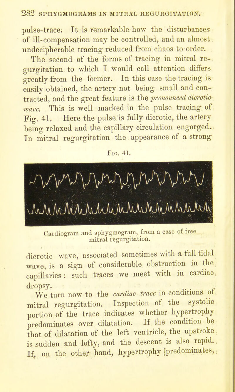 pulse-trace. It is remarkable how the disturbances of ill-compensation may be controlled, and an almost undecipherable tracing- reduced from chaos to order. The second of the forms of tracing- in mitral re- g-urg-itation to which I would call attention differs greatly from the former. In this case the tracing is easily obtained, the artery not being small and con- tracted, and the great feature is the pronounced dicrotic ivavc. This is well marked in the pulse tracing of Fig. 41. Here the pulse is fully dicrotic, the artery being relaxed and the capillary circulation engorged. In mitral regurgitation the appearance of a strong- Fig. 41. Cardiogram and sphygmograin, from a case of free mitral regurgitation. dicrotic wave, associated sometimes with a full tidal wave, is a sign of considerable obstruction in the capillaries: such traces we meet with in cardiac dropsy. We turn now to the cardiac trace in conditions ot mitral regurgitation. Inspection of the systolic portion of the trace indicates whether hypertrophy predominates over dilatation. If the condition be that of dilatation of the left ventricle, the upstroke is sudden and lofty, and the descent is also rapid. If, on the other hand, hypertrophy [predominates,