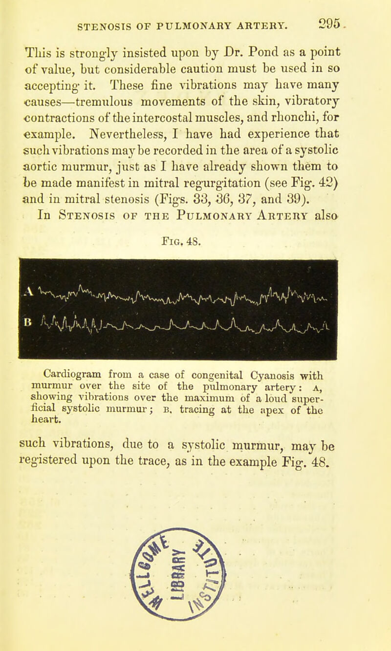 STENOSIS OF PULMONARY ARTERY. This is strongly insisted upon by Dr. Pond as a point of value, but considerable caution must be used in so accepting- it. These fine vibrations may have many causes—tremulous movements of the skin, vibrator3r •contractions of the intercostal muscles, and rhonchi, for example. Nevertheless, I have had experience that such vibrations maybe recorded in the area of a systolic aortic murmur, just as I have already shown them to be made manifest in mitral regurgitation (see Fig. 42) and in mitral stenosis (Figs. 33, 36, 37, and 39). In Stenosis of the Pulmonary Artery also Fig. 48. Cardiogram from a case of congenital Cyanosis with murmur oyer the site of the pulmonary artery: a, showing vibrations over the maximum of a loud super- ficial systolic murmur; b. tracing at the apex of the heart. such vibrations, due to a systolic murmur, may be registered upon the trace, as in the example Fig. 48.