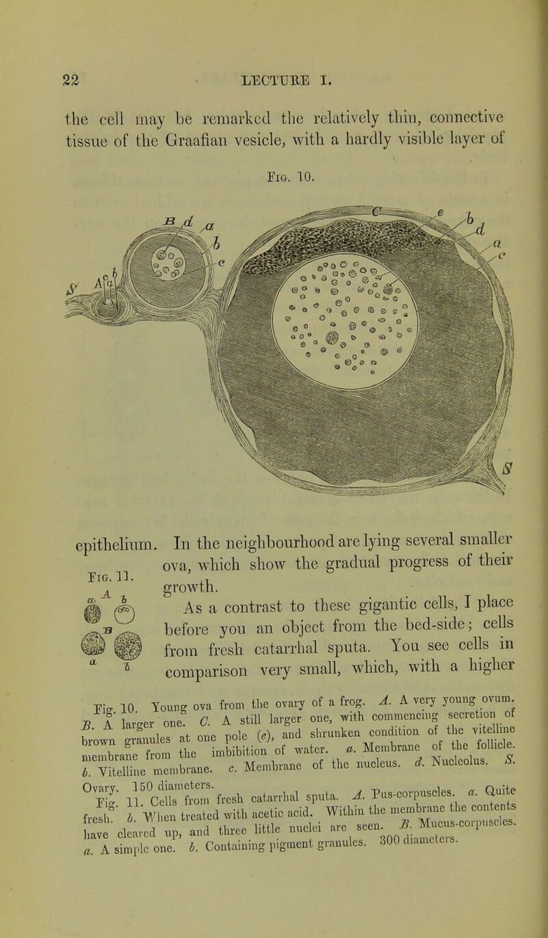 the cell may be remarked the relatively thin, connective tissue of the Graafian vesicle, with a hardly visible layer of Fig. 10. Eig. 11. f a epithelium. In the neighbourhood are lying several smaller ova, which show the gradual progress of their growth. Asa contrast to these gigantic cells, I place before you an object from the bed-side; celts from fresh catarrhal sputa. You see cells in comparison very small, which, with a higher Fi. 10 Young ova from the ovary of a frog. A. A very young ovum 7? A larger one C. A still larger one, with commencing secretion of B. A larger one. sliruukeu condition of the vitelline brown granules at one poic \e), f„n;ni« membrane from the imbibition of water, a. Membrane of the follicle. TvUemne membrane. * Membrane of the nucleus, d. Nucleolus. S. 0eS nCeirfrom'fresh catarrhal sputa. A. Pus-corpuscles a. Quite Jj' Ä When treated with acetic acid. Within the membrane the contents ;b Ä «- little nuclei are see. J a. A simple one. b. Containing pigment granules. 300 diameters.